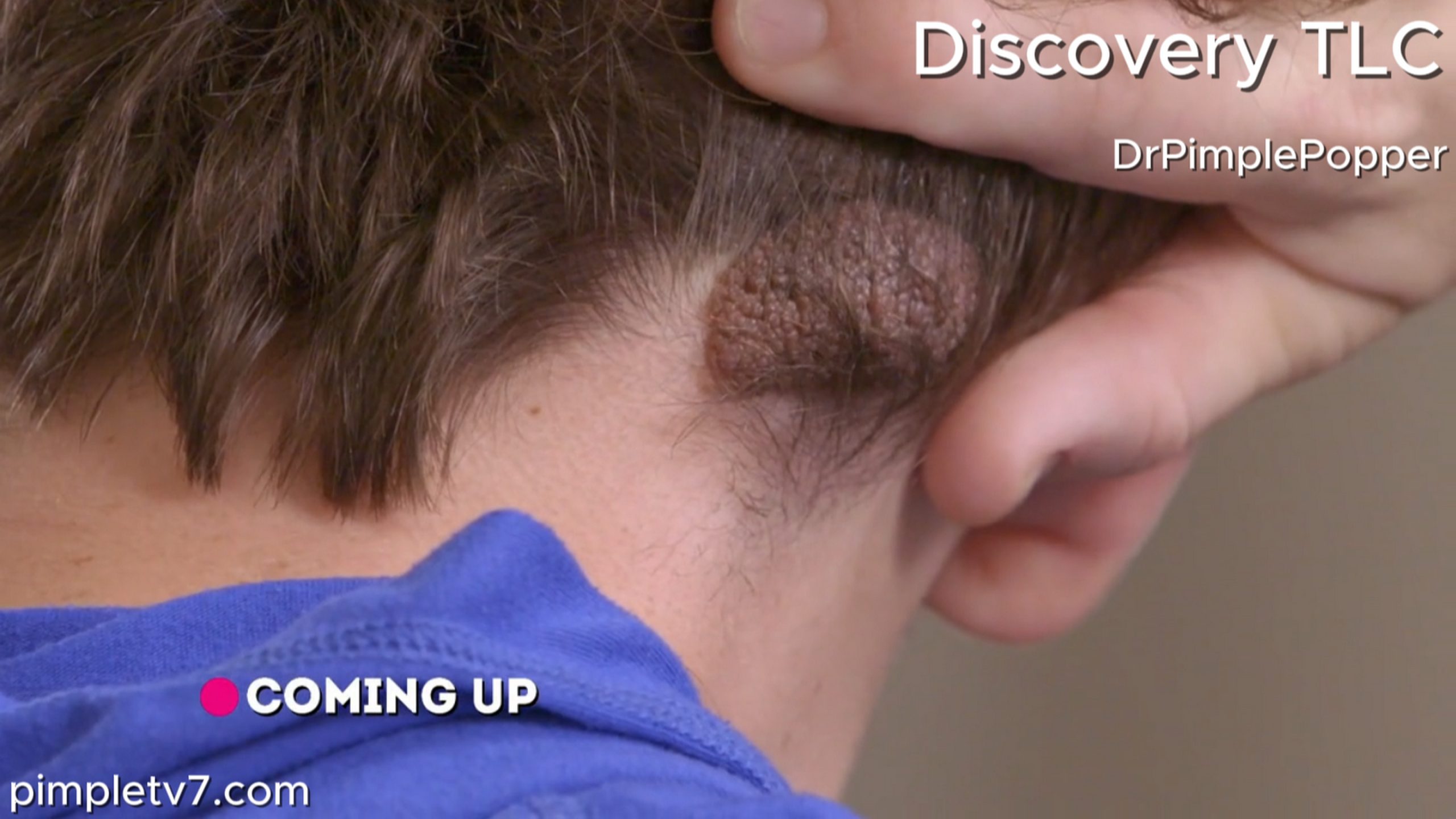 Gabe cannot imagine going off to college with the unsightly mole on the back of his head. Dr. Pimple Popper 170726