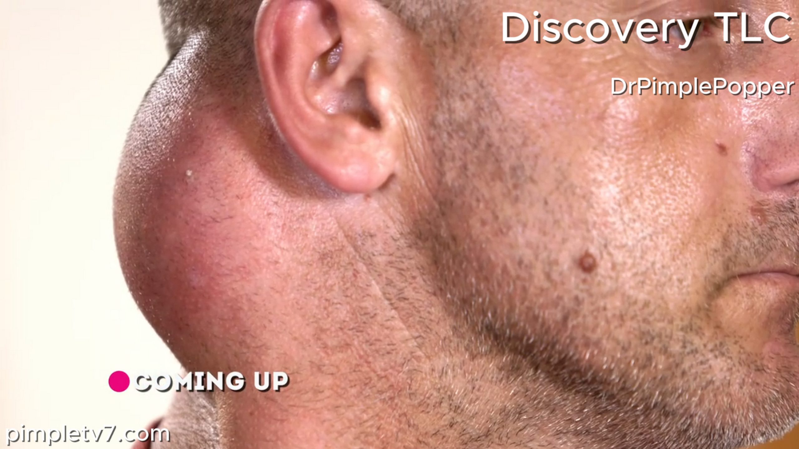 Jason has lost confidence and motivation due to the large growth on his neck. Dr. Pimple Popper 010726