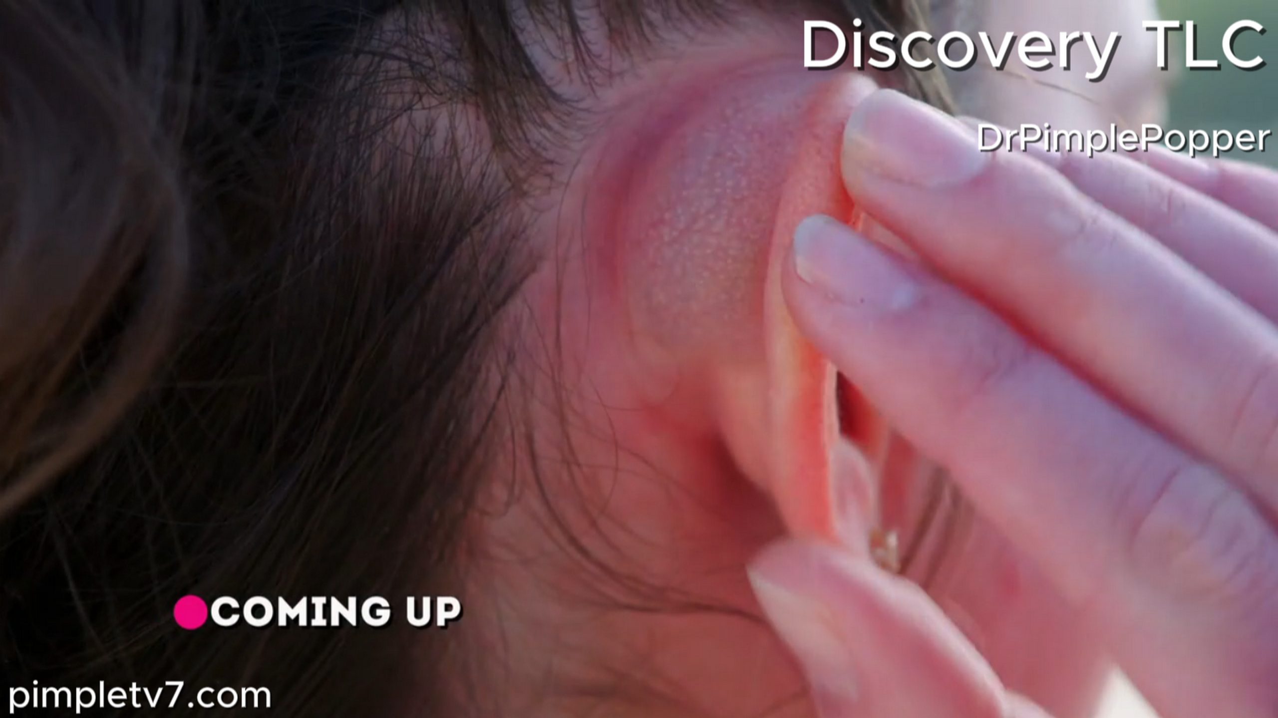 Jenna is a bubbly teenager with an even bigger bubble behind her ear. Dr. Pimple Popper 020726
