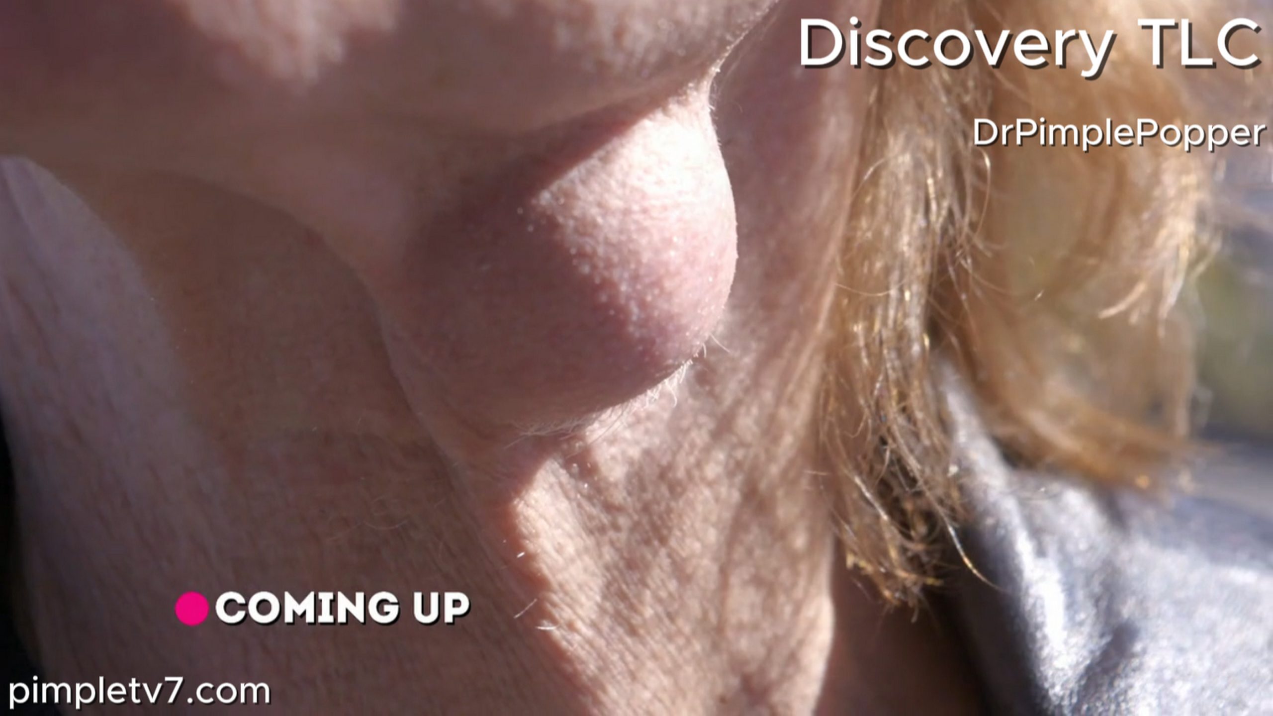 Jerry had to hang up his rock star vocal cords when a lump grew on the side of his throat. Dr. Pimple Popper 120726