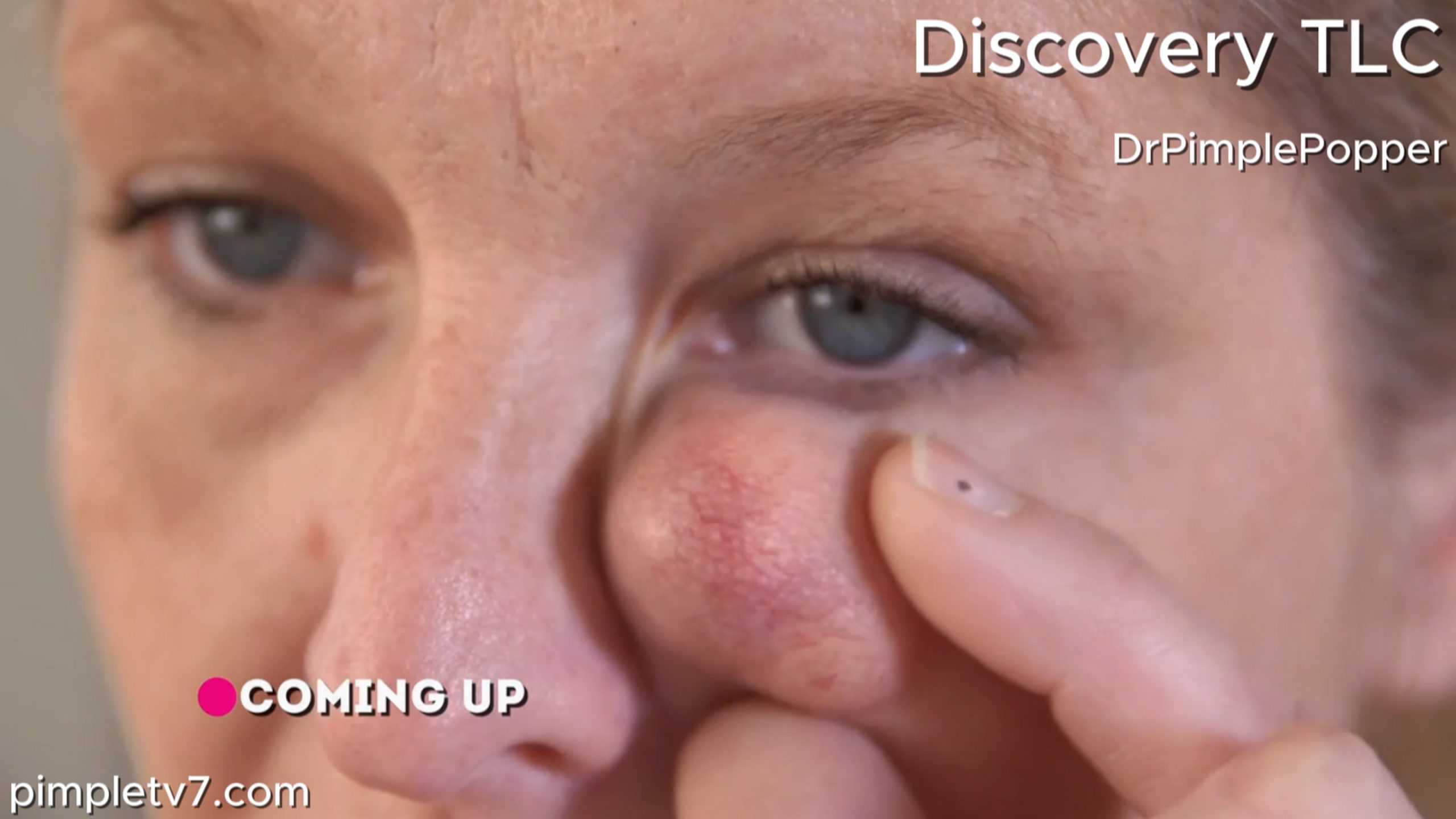 Jessica’s cyst is close to her eye and could be dangerous for Dr. Lee to remove. Dr. Pimple Popper 130726