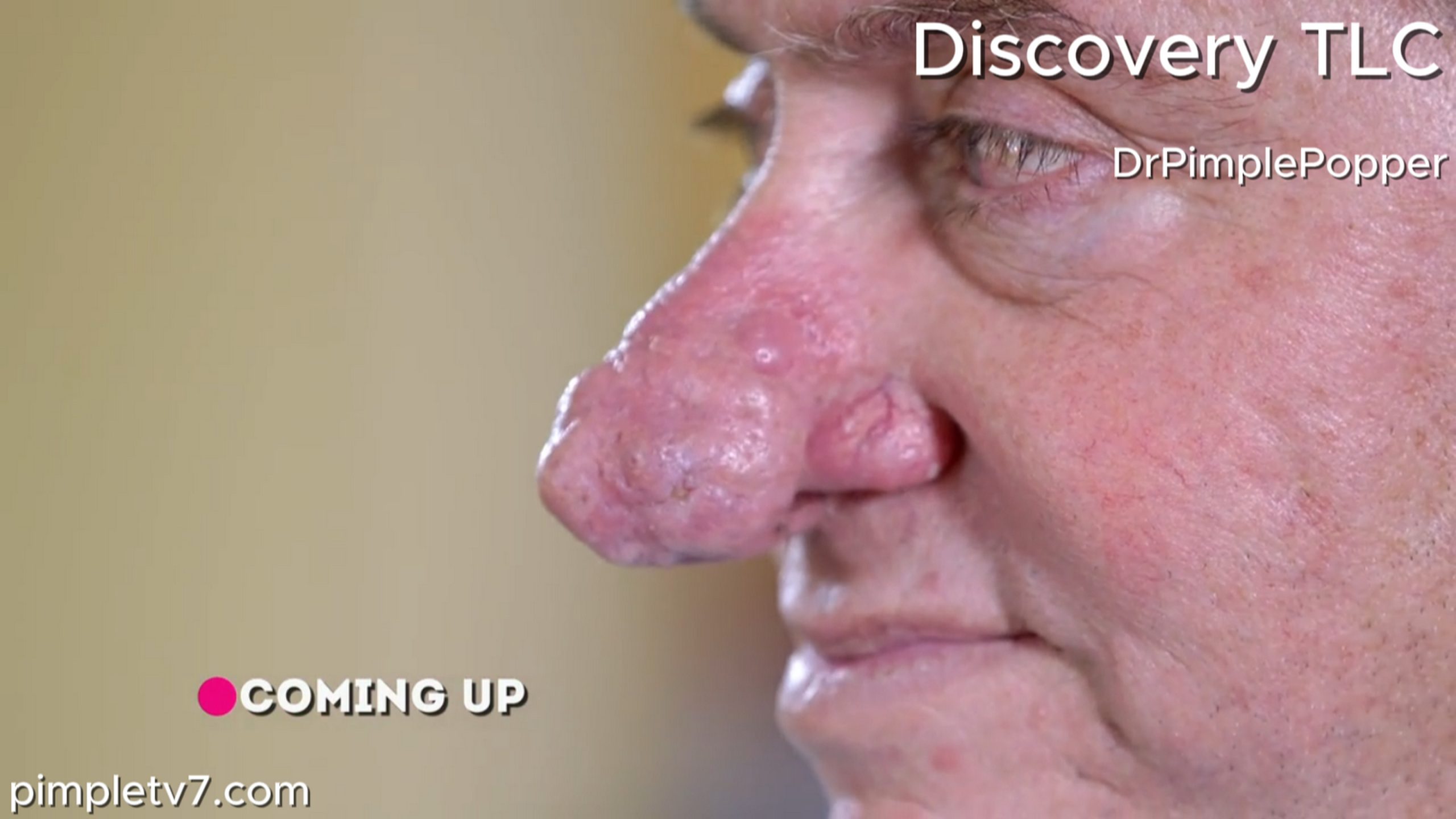 Jim has a growth protruding off of his nose, making it hard to breathe. Dr. Pimple Popper 010726