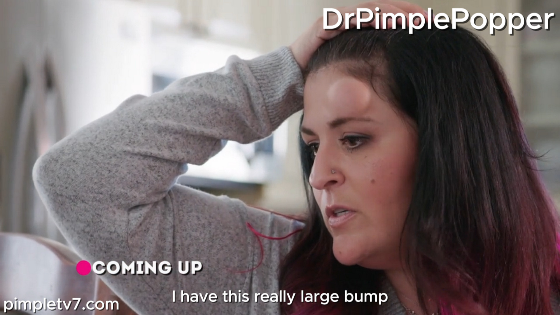 Joanne has been held back from success because of her forehead growth. Dr. Pimple Popper 290726