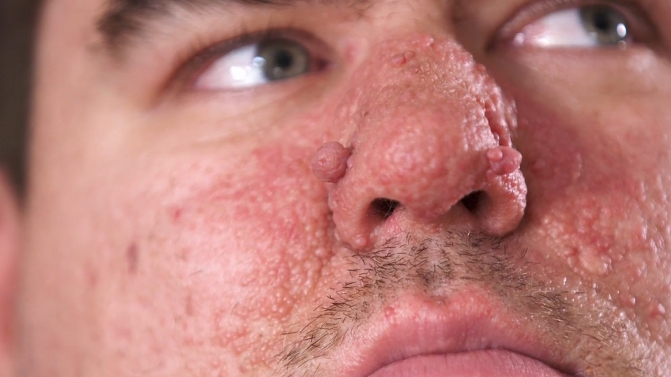 Jordan has autism and was born with a condition that causes small bumps to grow on his nose. Dr. Pimple Popper 190726