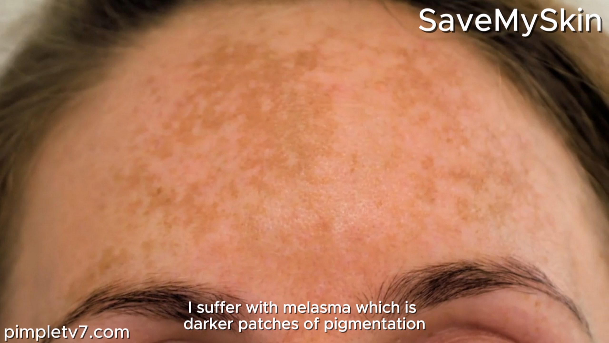 Jo’s melasma is making her self-conscious. SaveMySkin 170726