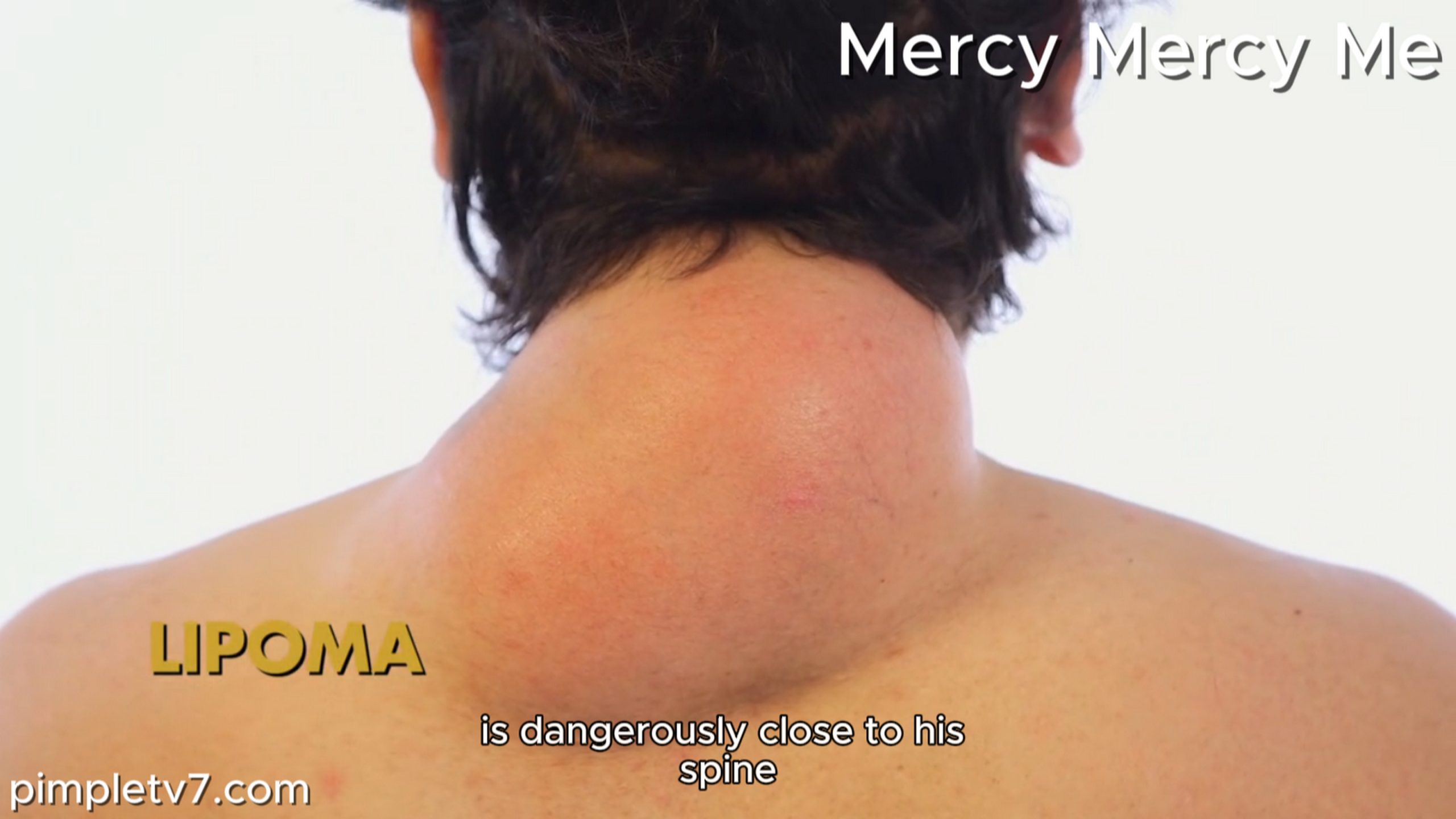 Joseph’s neck lipoma gets in the way of everything he does. Mercy Mercy Me 100726