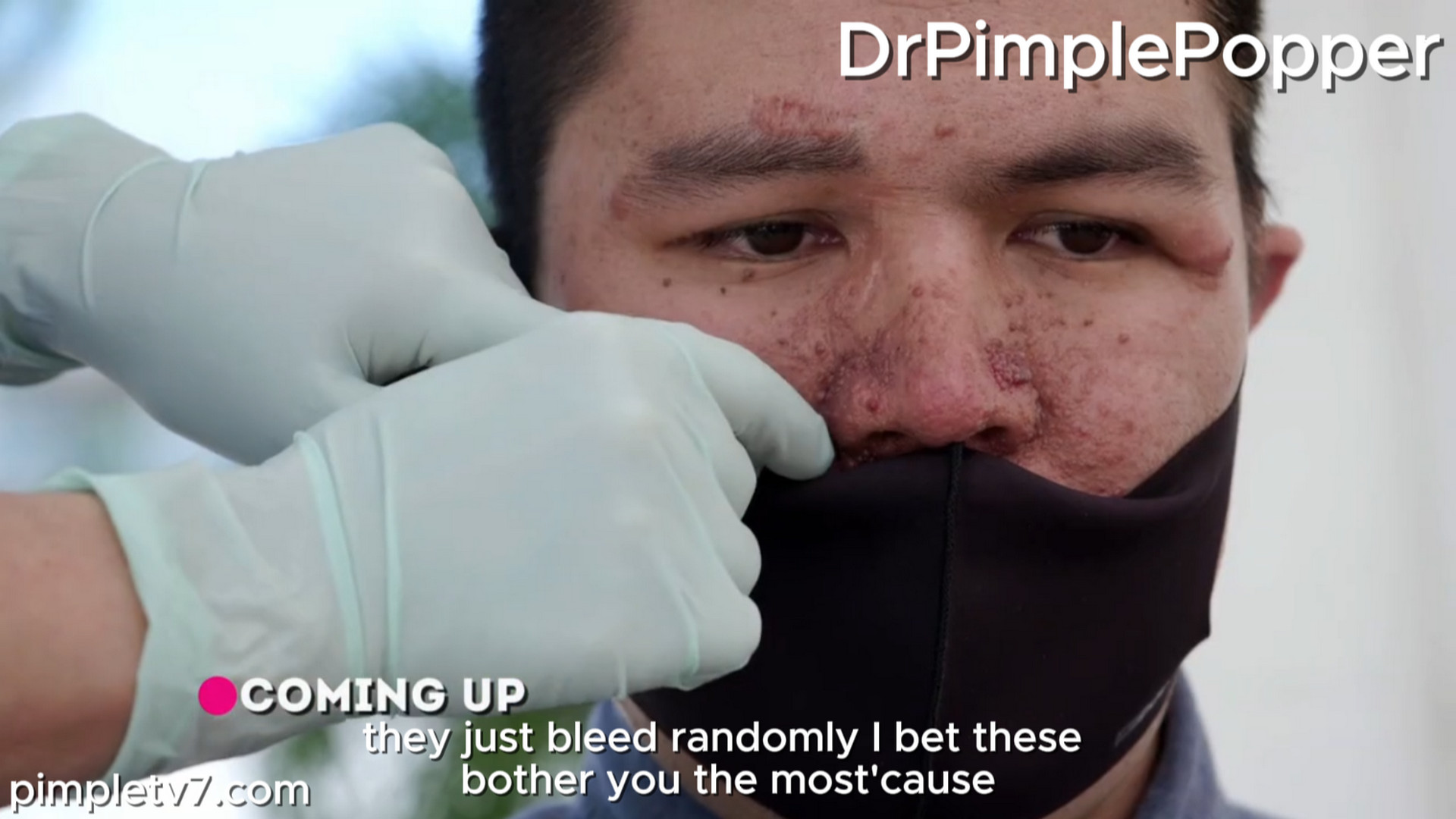 Juan has a rare condition he hopes Dr. Lee will understand. Dr. Pimple Popper 250726
