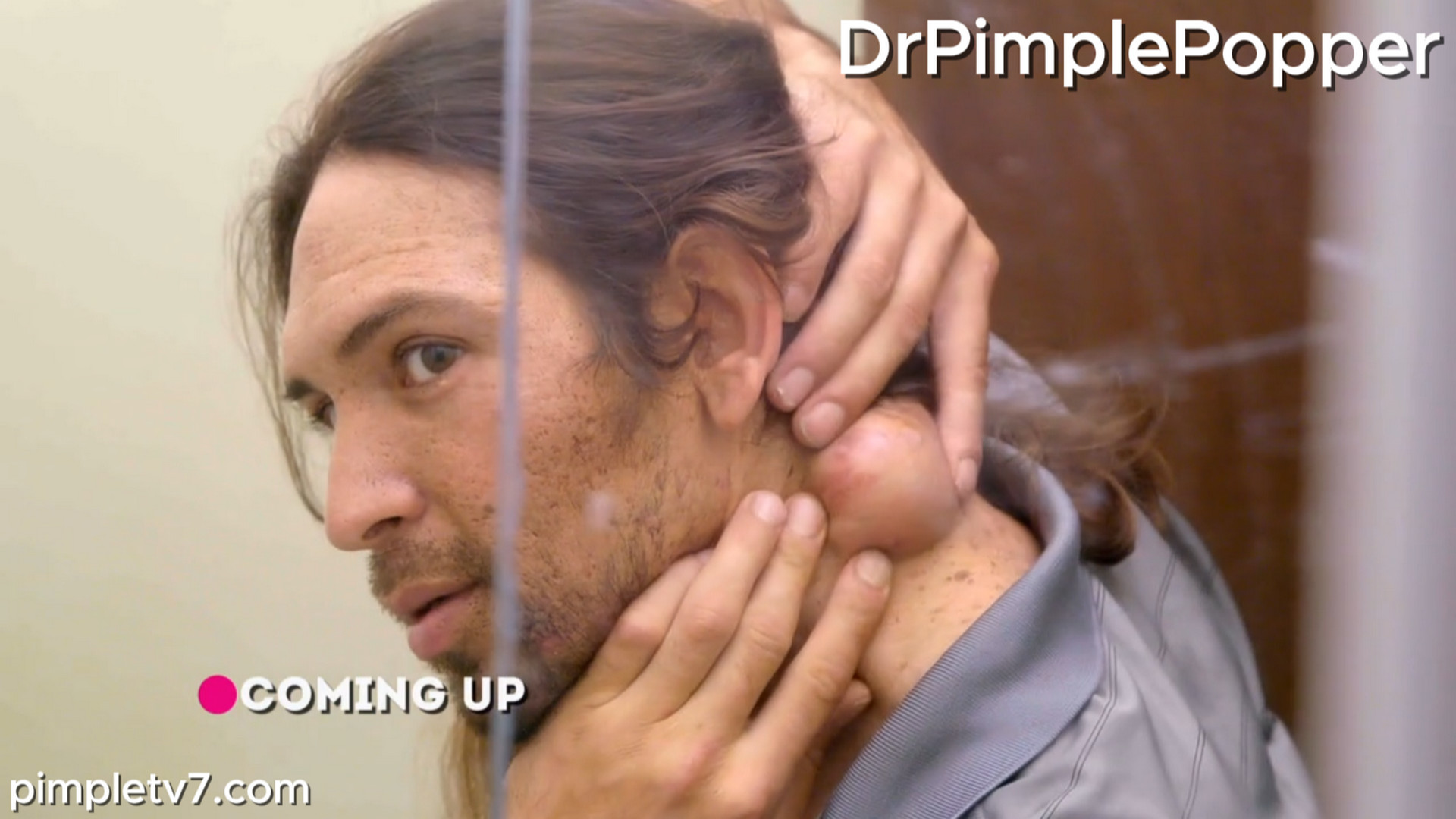 Juan has several painful boils on the back of his neck. Dr. Pimple Popper 230726