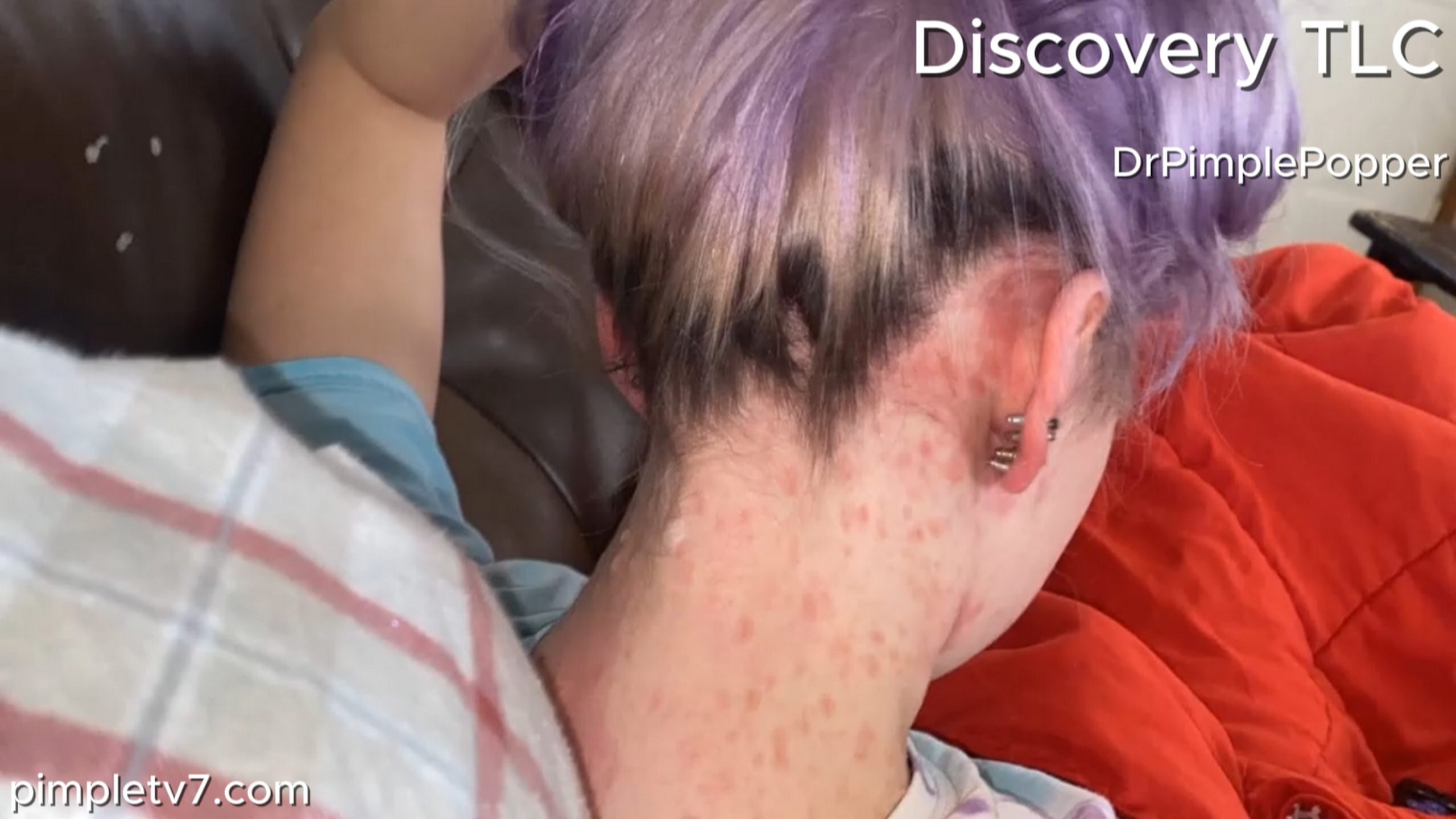 Justice has small lesions all over her body that get inflamed. Dr. Pimple Popper 050726