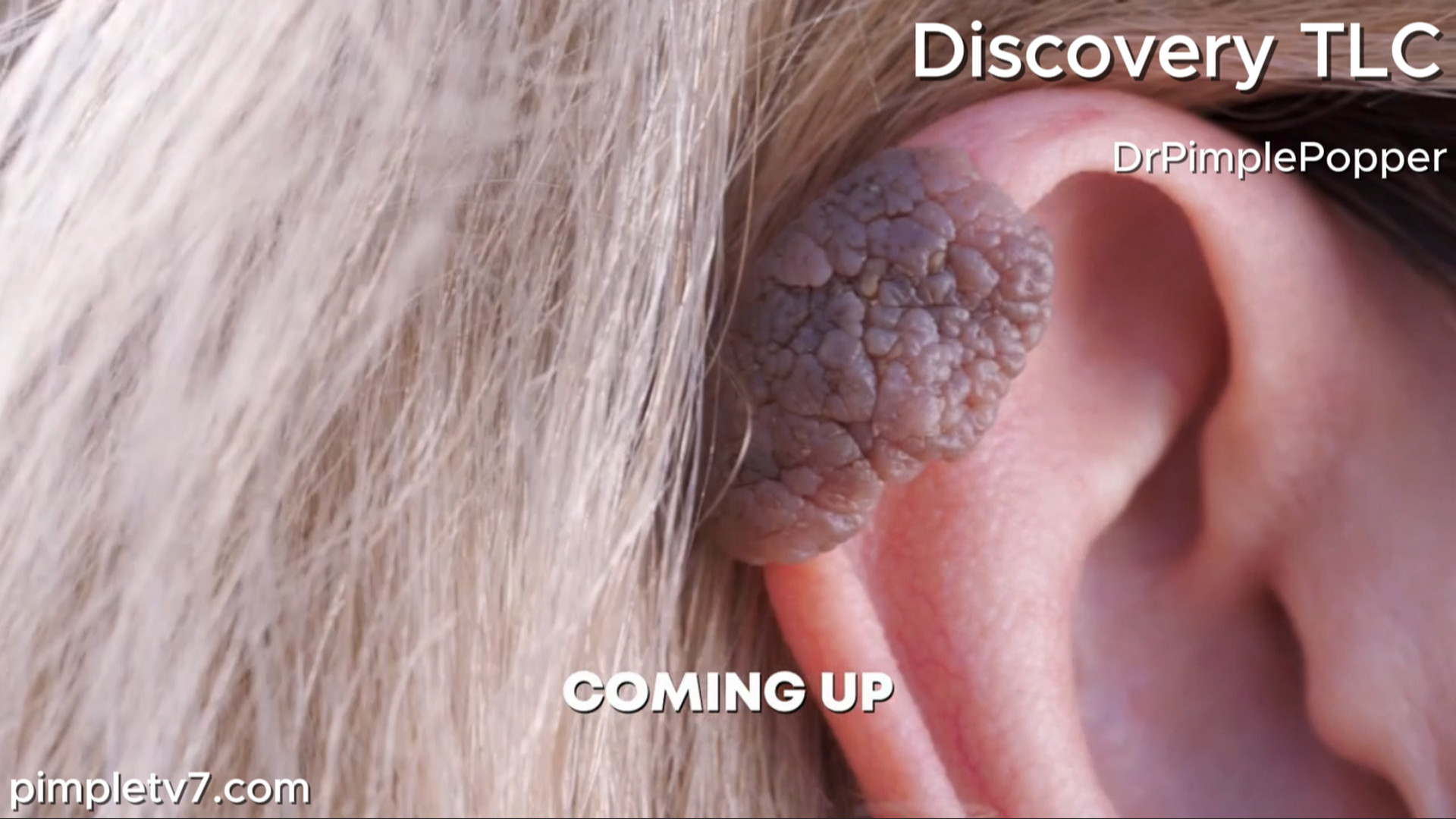 Katherine’s large ear cluster puts her neighborhood watch job at risk. Dr. Pimple Popper 230726