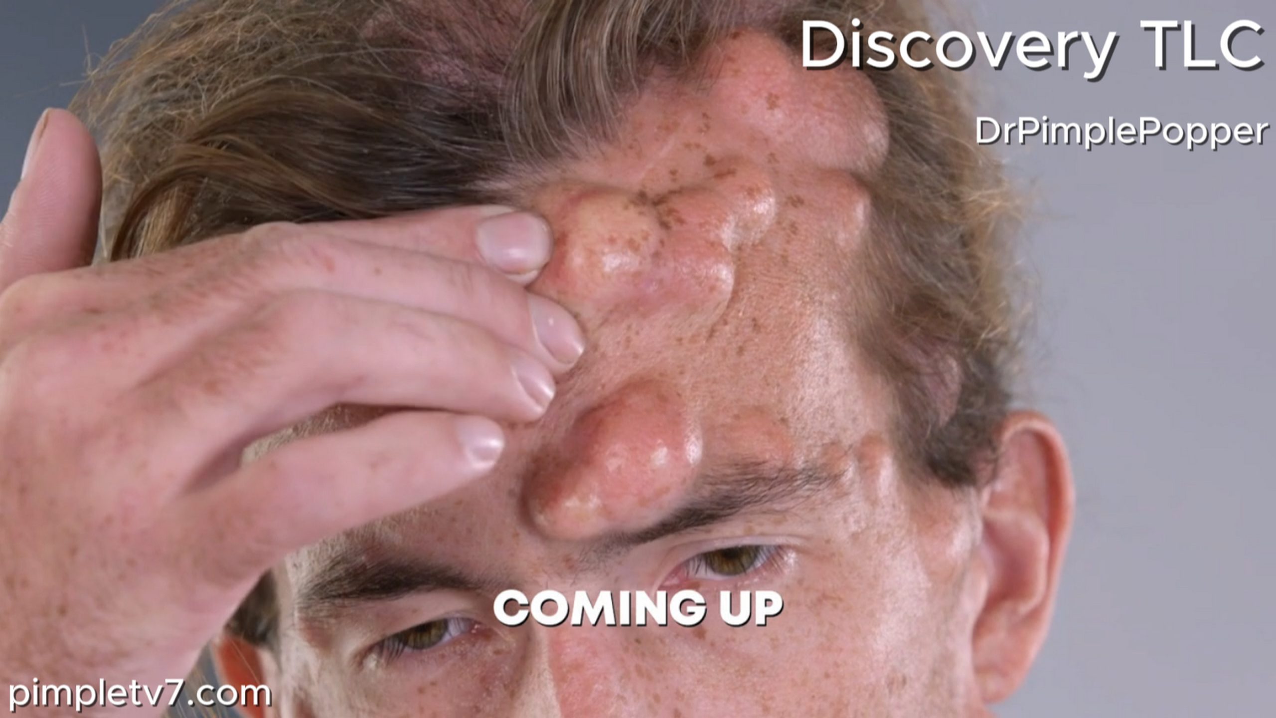 Kenny was born with a rare condition that causes hundreds of lumps to grow all over his body. Dr. Pimple Popper 180726