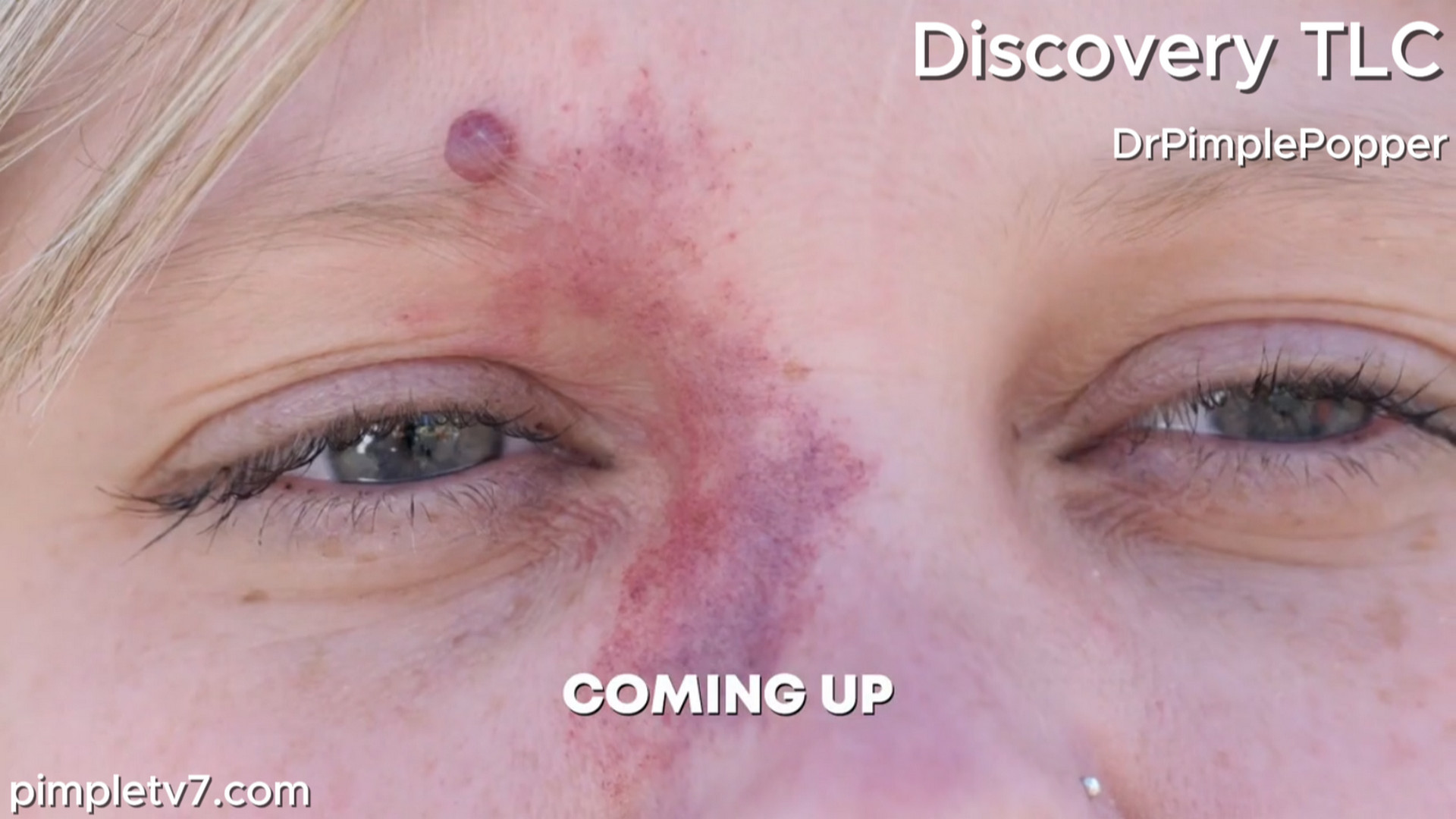 Kylie has come to love her birthmark and is torn about whether or not to get it removed. Dr. Pimple Popper 270726