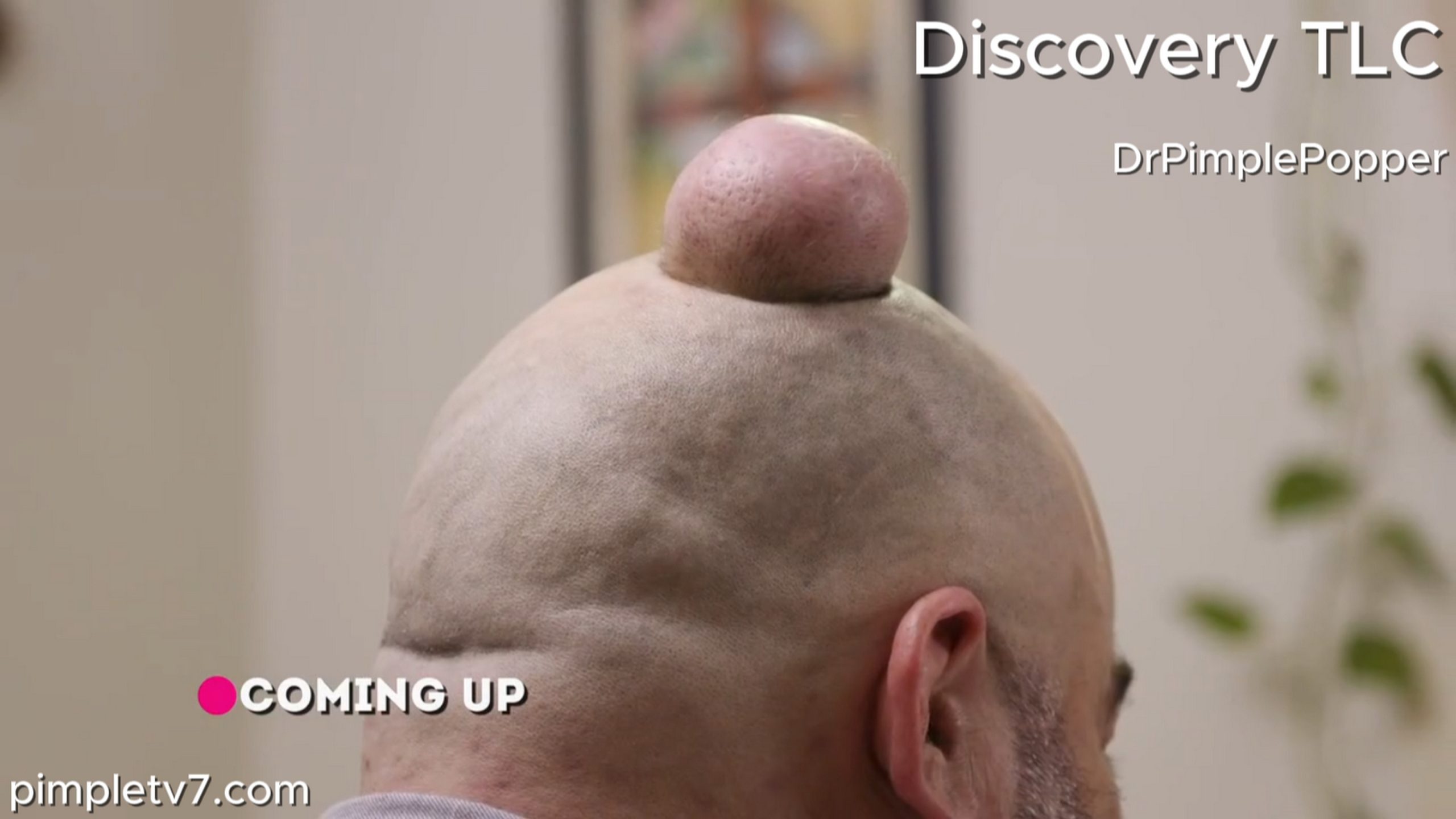 Michael makes jokes, but he knows the bump on his head is anything but funny. Dr. Pimple Popper 060726