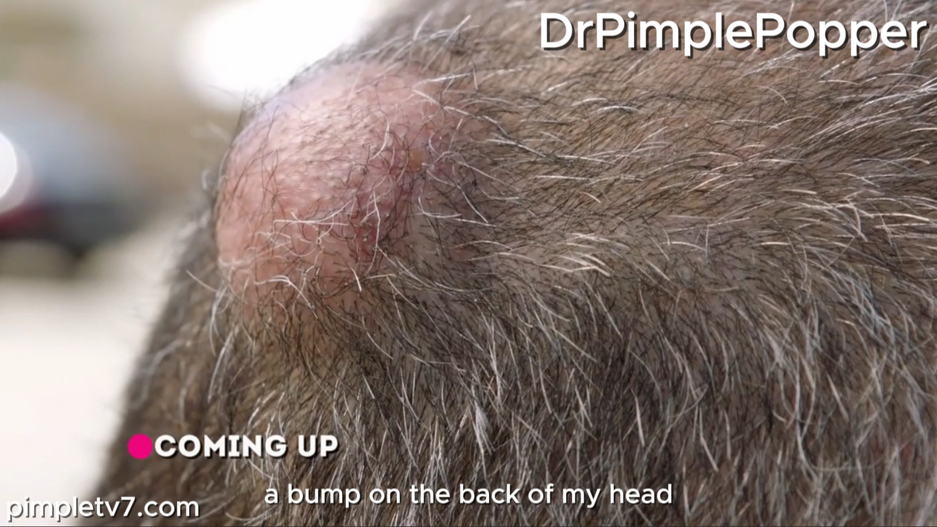 Mike is a tough guy with a soft bump on his head. Dr. Pimple Popper 300726