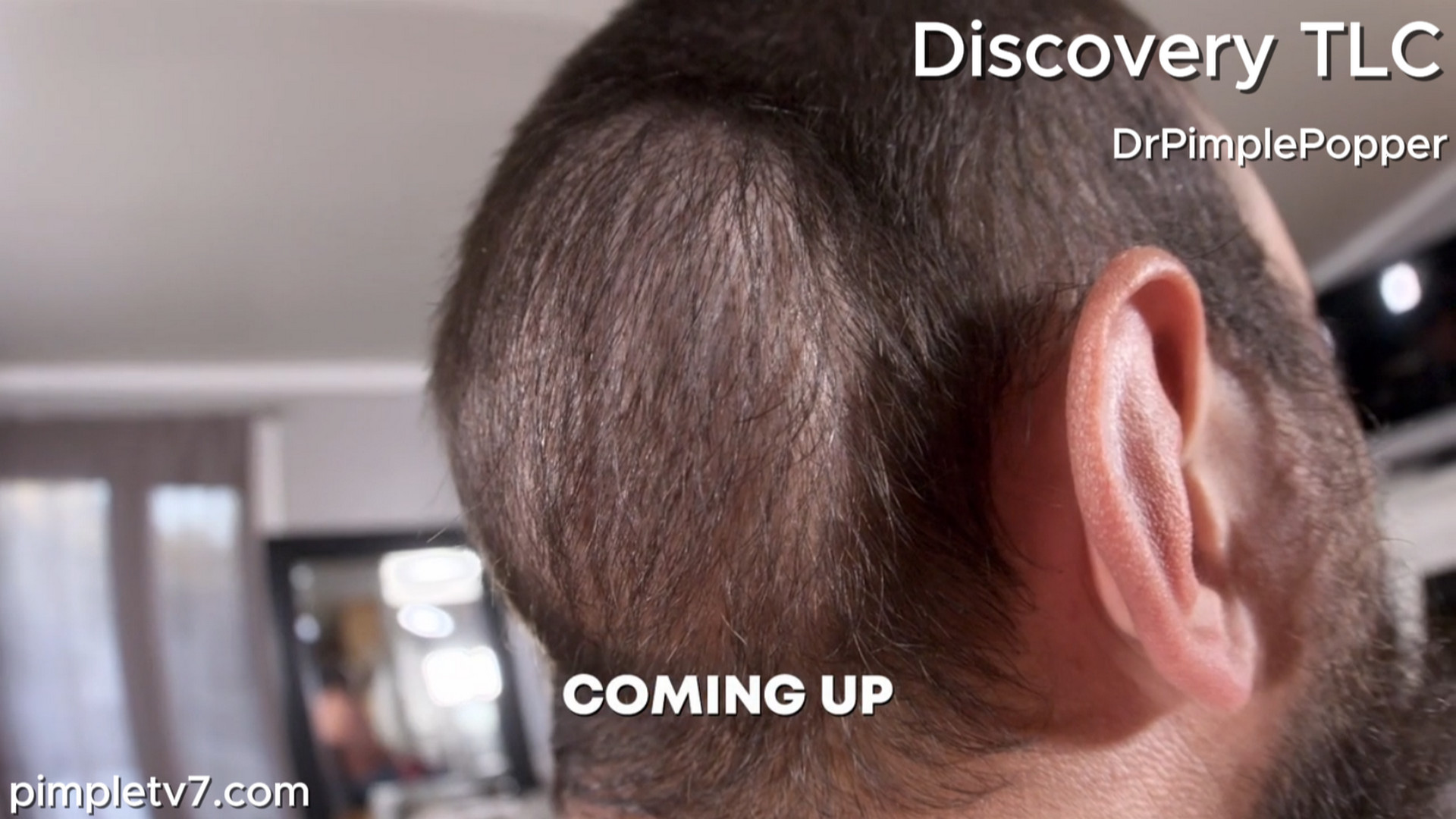 Mike needs to get rid of the bump on his head before two major life events. Dr. Pimple Popper 300726