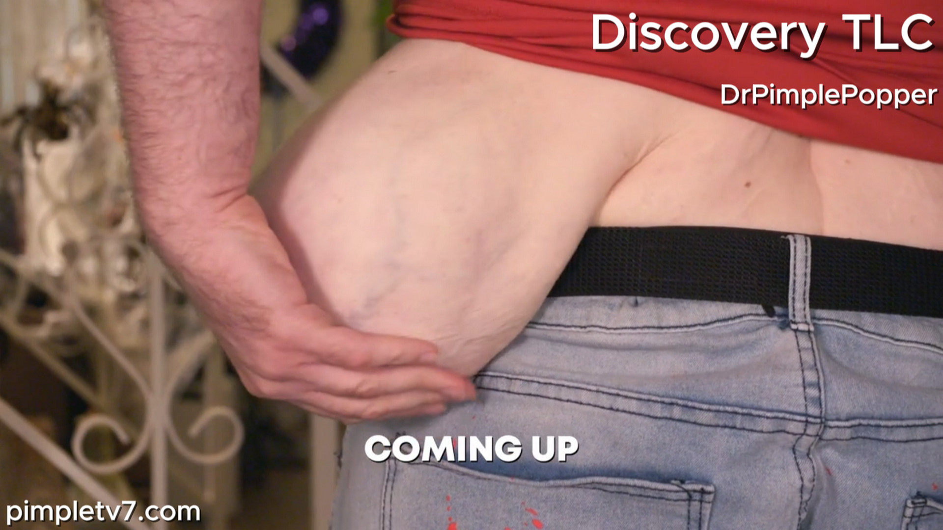 Mike’s religious beliefs have kept him from seeing a doctor about his huge growth. Dr. Pimple Popper 260726