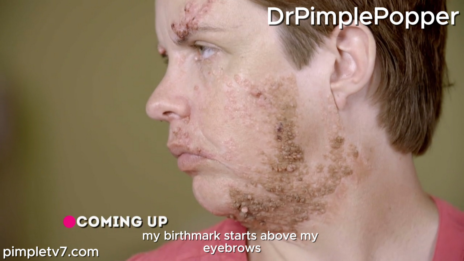 Monica has a large birthmark growing on the side of her face. Dr. Pimple Popper 220726