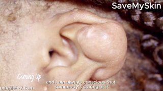 Onique can feel the people staring at the lump on her ear. SaveMySkin 270726