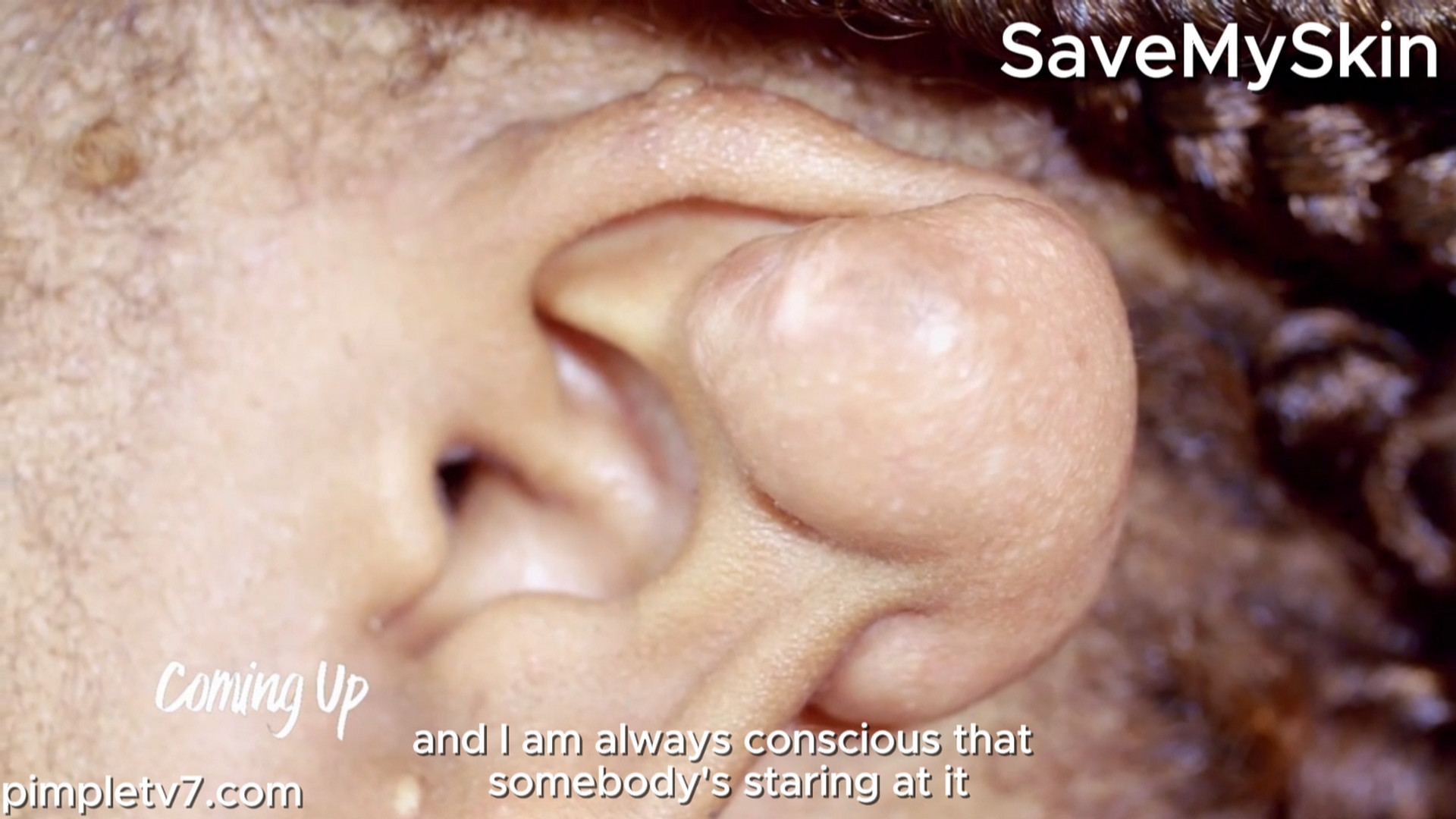 Onique can feel the people staring at the lump on her ear. SaveMySkin 270726