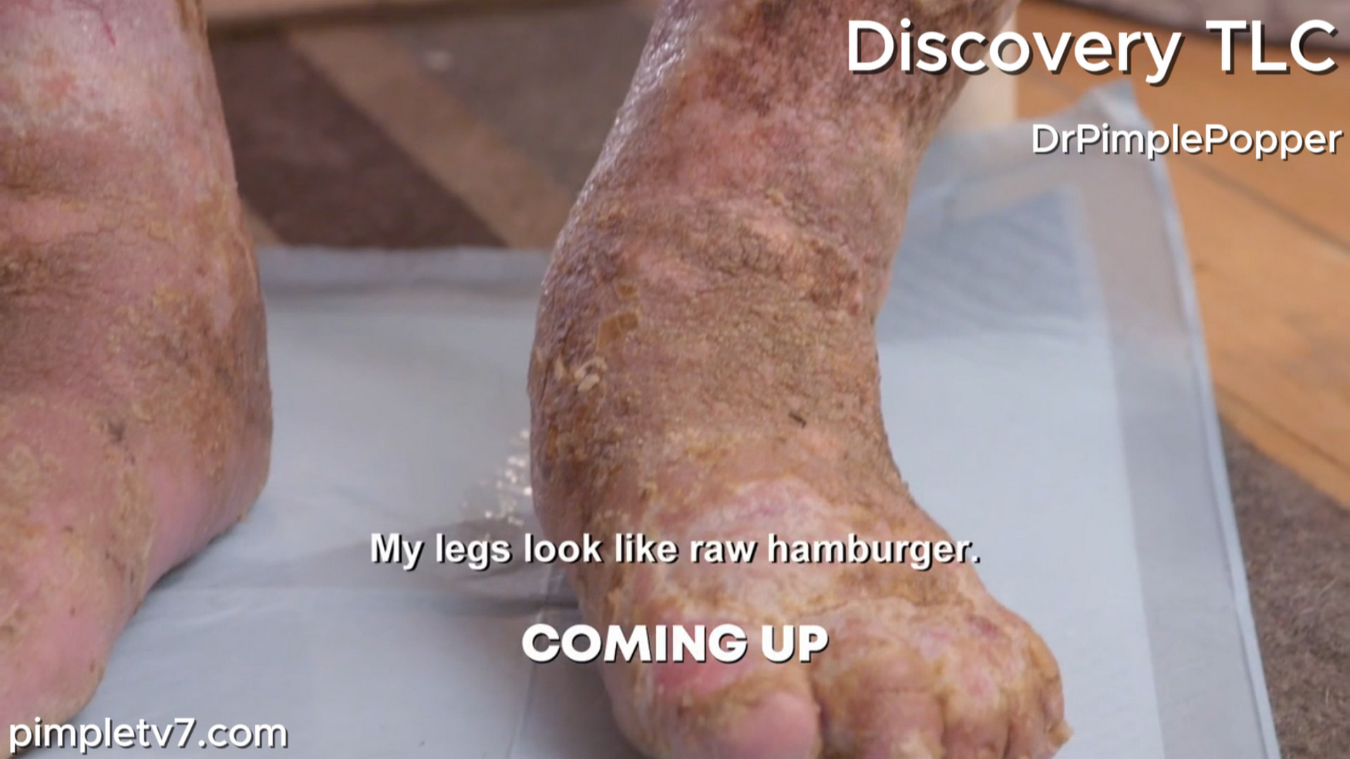 Paula’s painful and swollen feet ooze a substance that emits the foulest of odors. Dr. Pimple Popper 290726