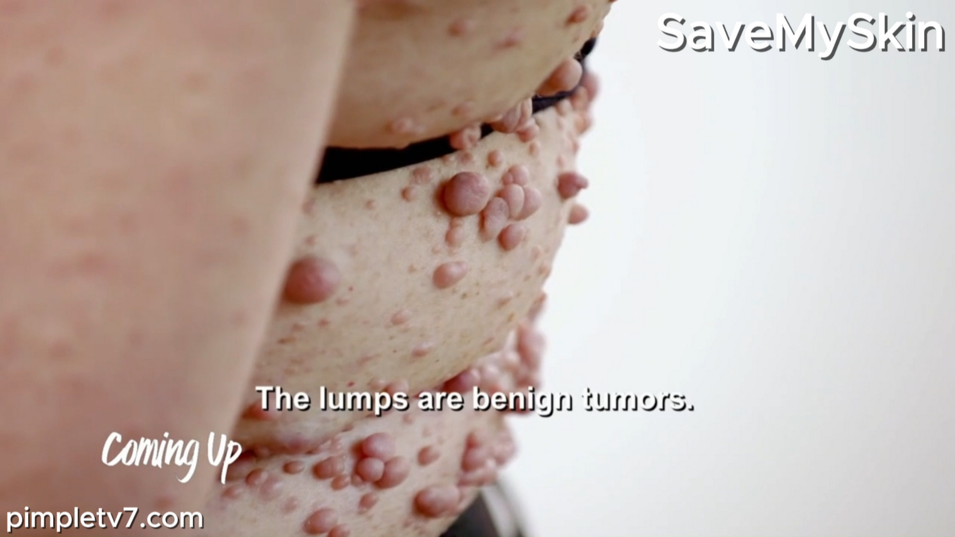 Rachael’s body is covered in hundreds of squishy bumps. SaveMySkin 280726