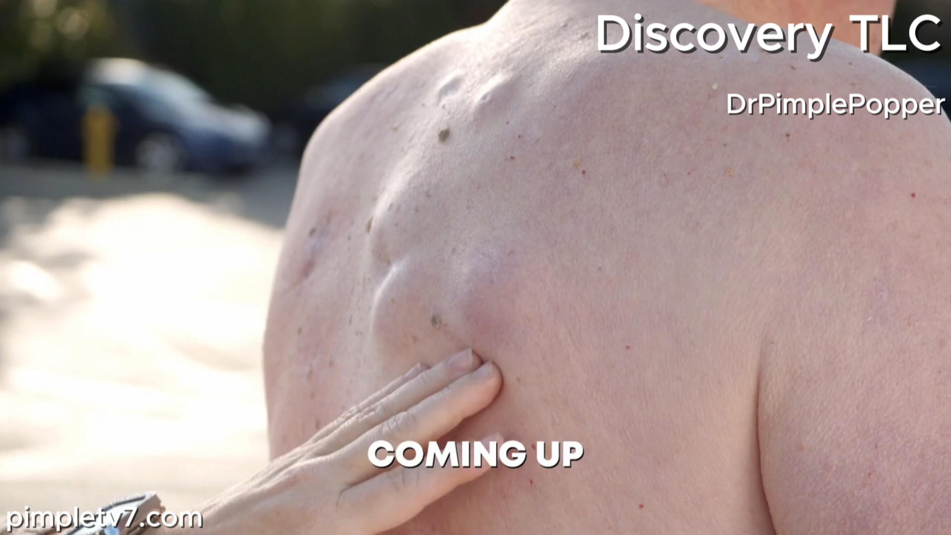 Ralph feels like a “cyst factory” with painful cysts covering his back. Dr. Pimple Popper 270726