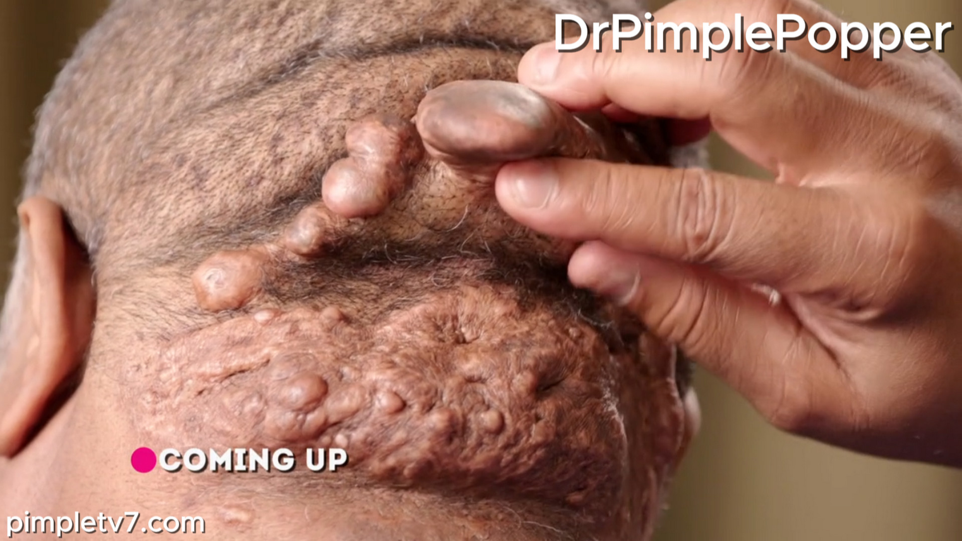 Reginald has large, rare growths on the back of his head. Dr .Pimple Popper 230726