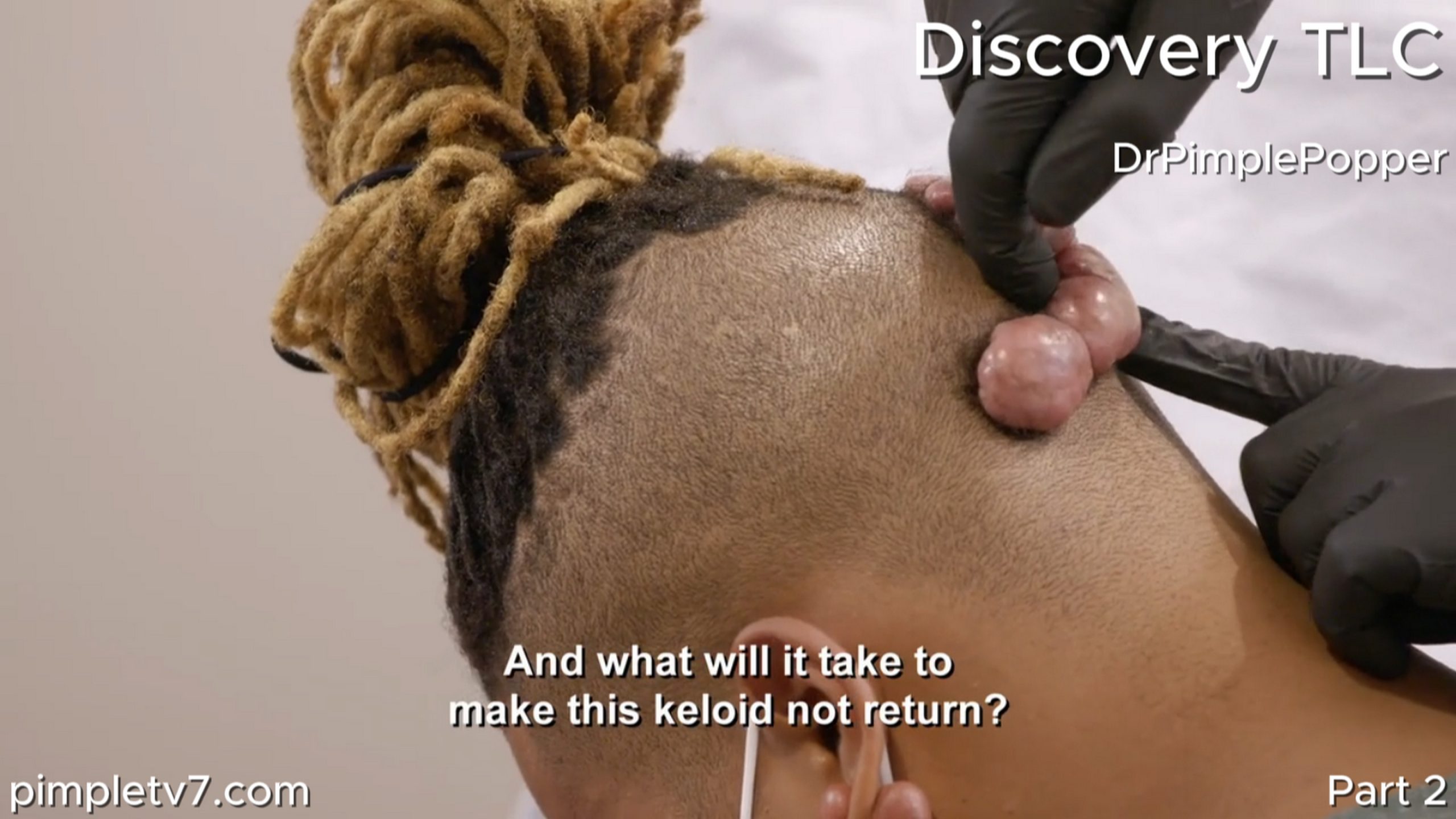 Robert has a small keloid on his ear and a large, snakelike keloid on the back of his head that has been removed and returned three times. Dr. Pimple Popper 030726
