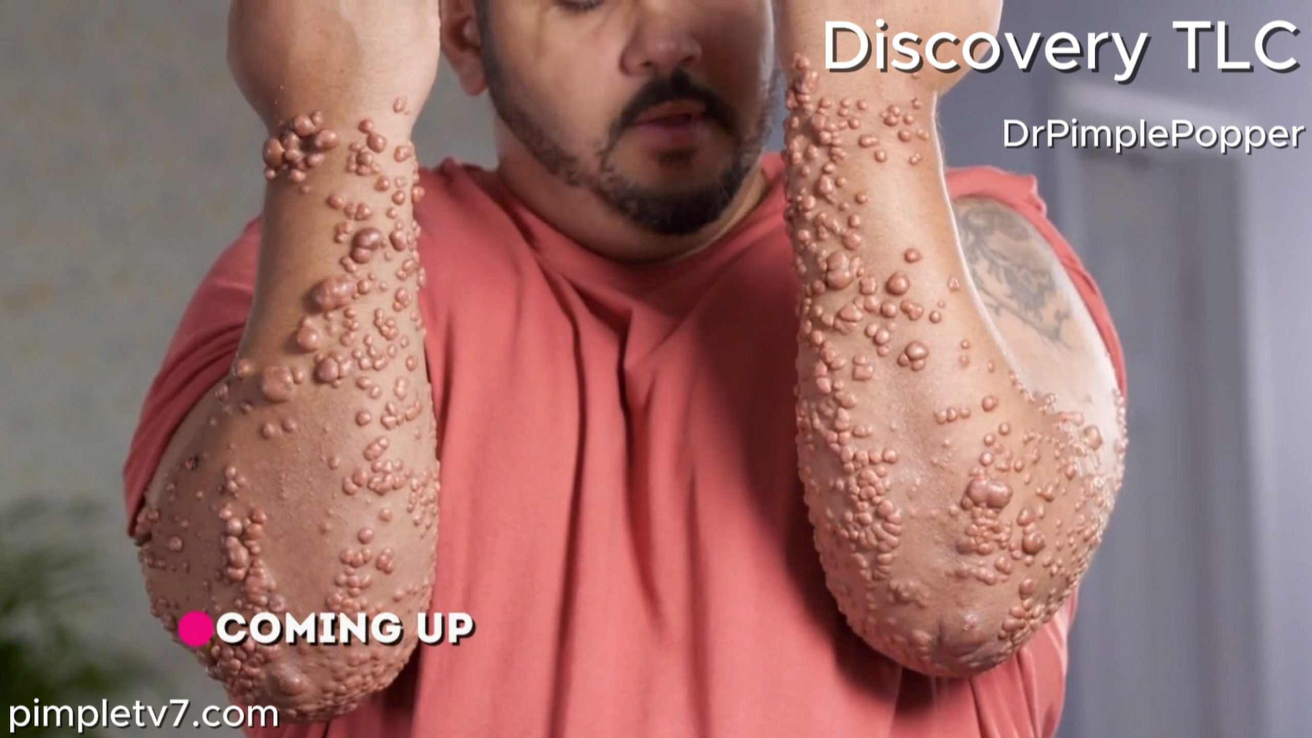 Robert has thousands of unique bumps on his arms that Dr. Lee has never seen. Dr. Pimple Popper 100726