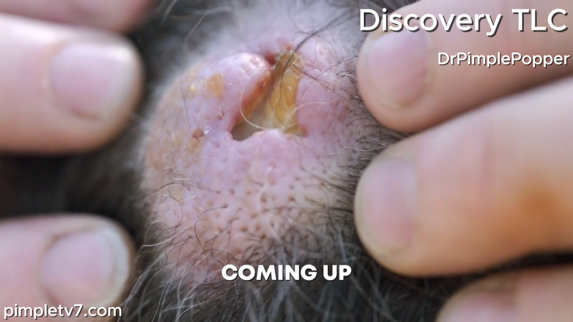 Shad’s head bump has burst open and smells like death. Dr. Pimple Popper 260726