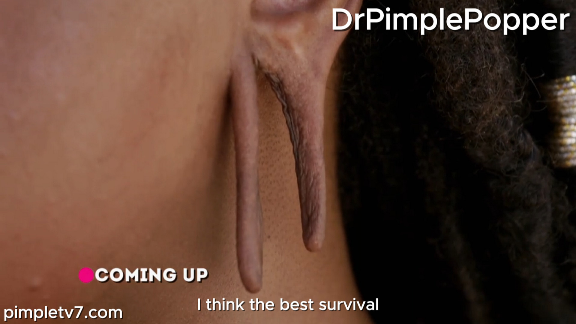 Shakisaha split her left earlobe after stretching it with gauges. Dr. Pimple Popper 300726