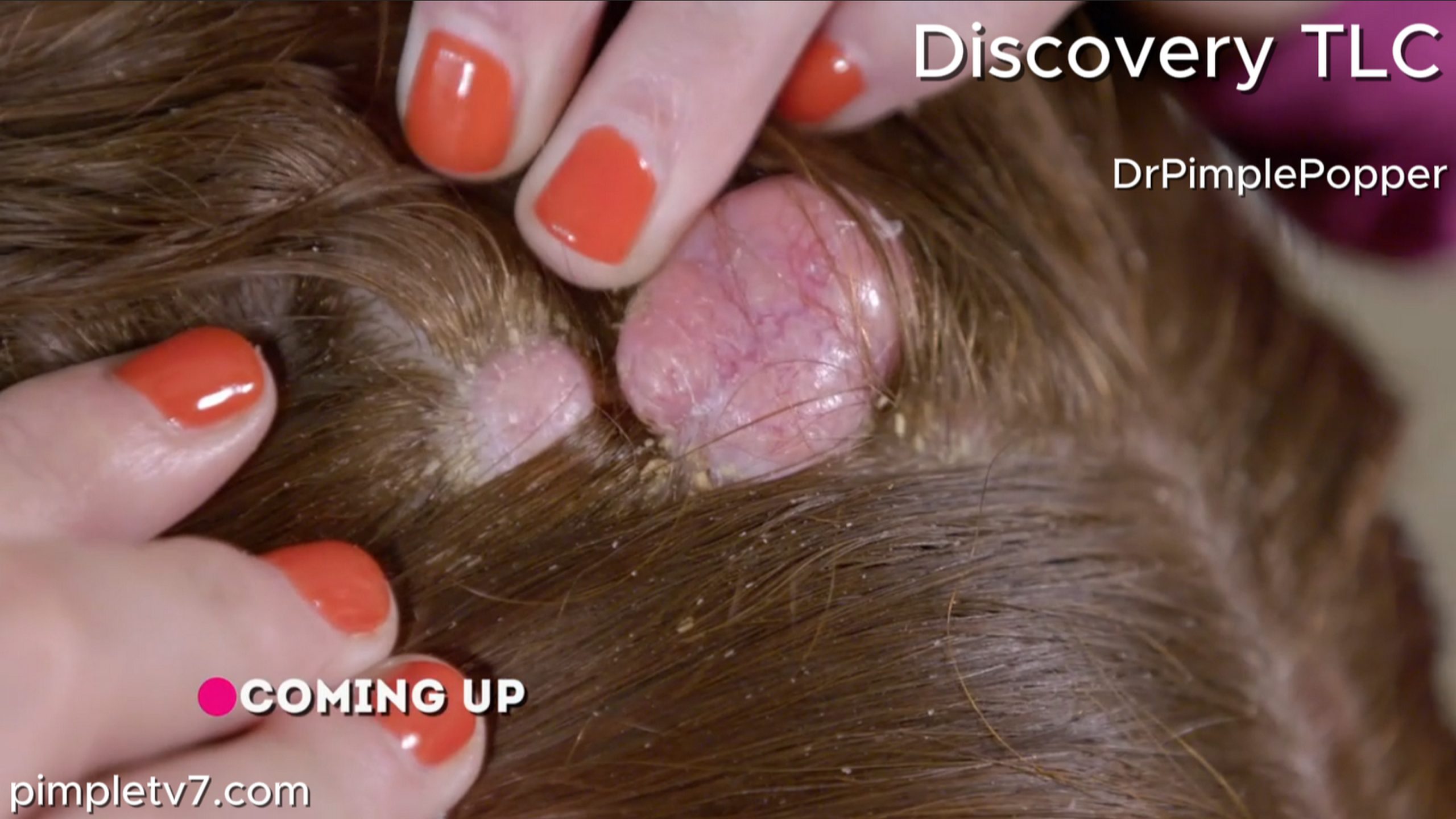 Shawnell has multiple mystery bumps on her head that have destroyed her self-esteem. Dr. Pimple Popper 010726