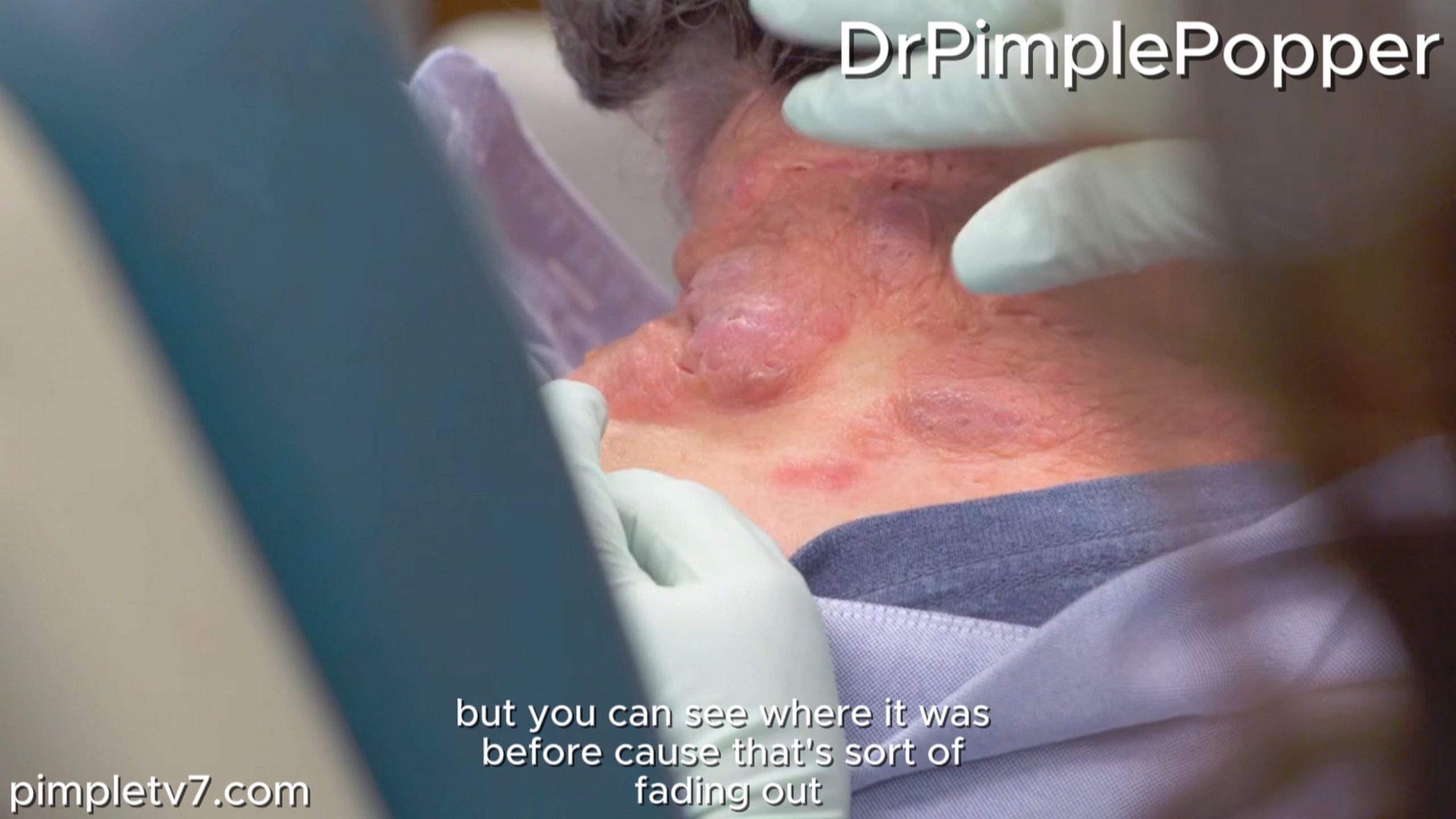Siblings suffer from the same painful skin condition. Dr. Pimple Popper 110726