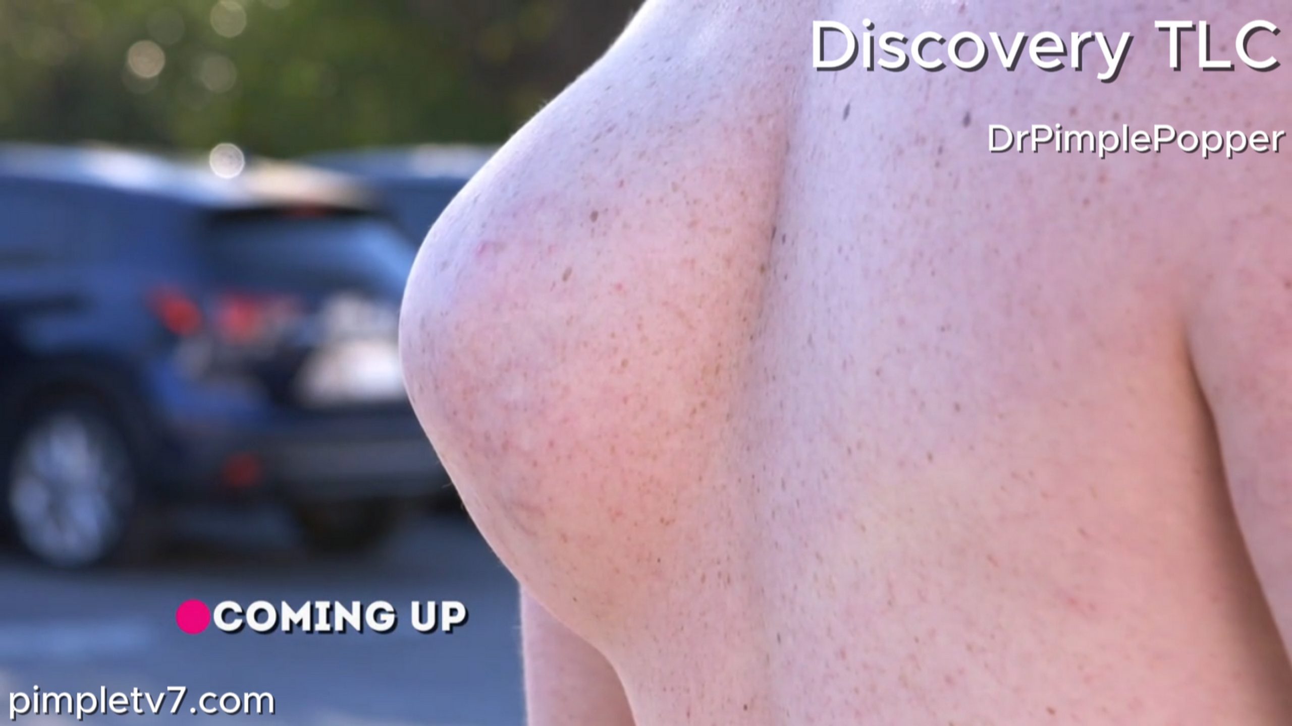 Steven’s bump is so large, his daughter thinks he is growing a monster on his back. Dr. Pimple Popper 170726