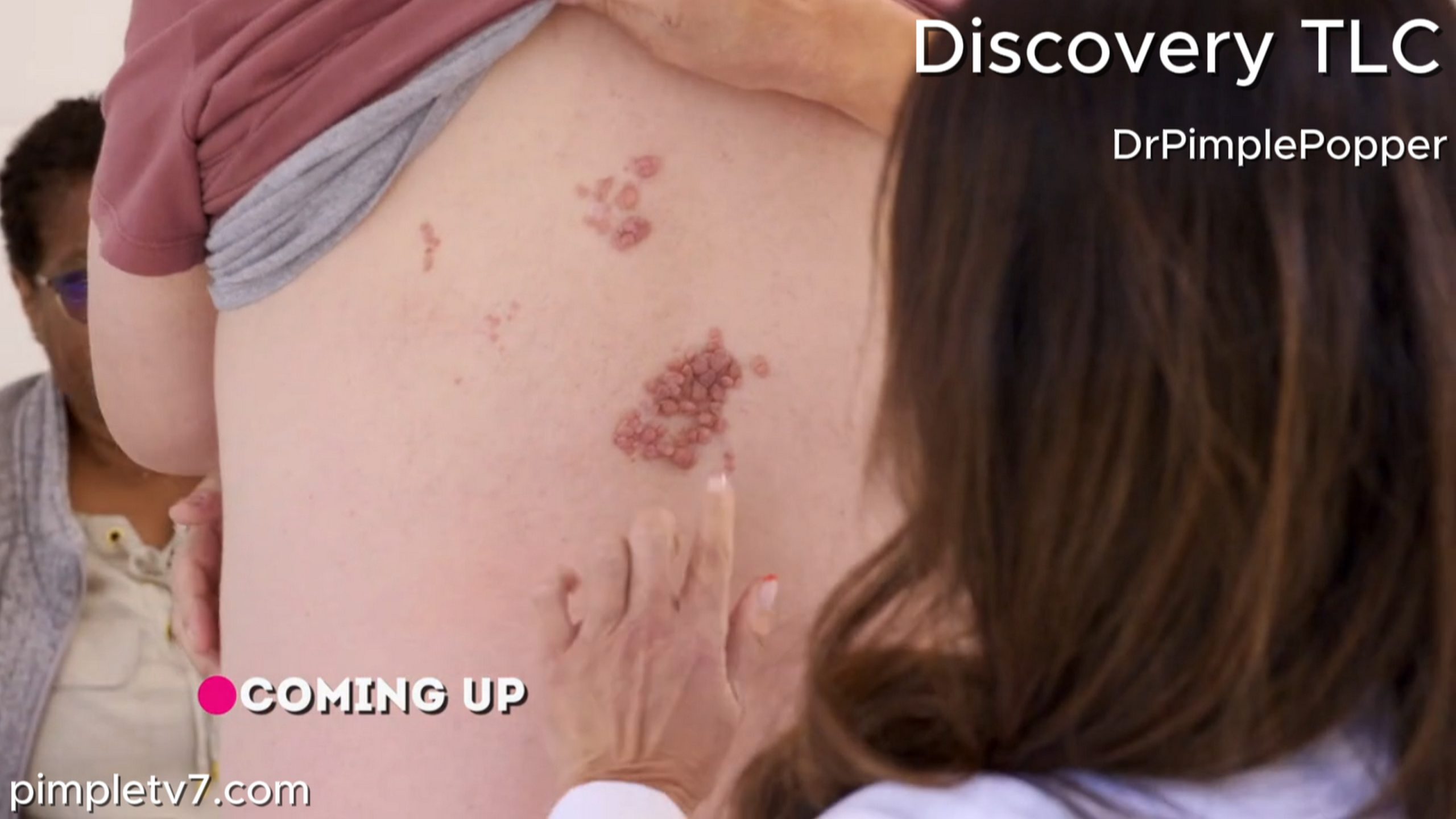Stuart’s cluster of back bumps disgusts his wife but thrills Dr. Lee. Dr. Pimple Popper 110726