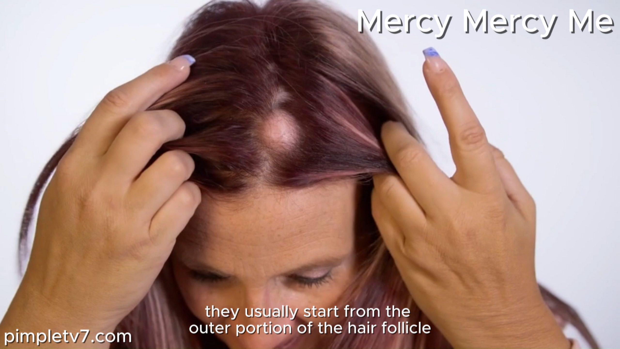 Summer has seven cysts, including one she calls her “unicorn horn.” Mercy Mercy Me 110726