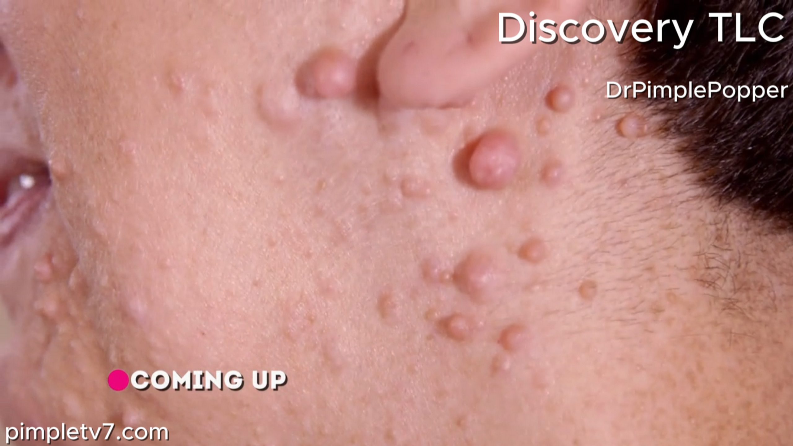 Susan is covered head to toe in bumps that get in the way of her everyday life. Dr. Pimple Popper 020726
