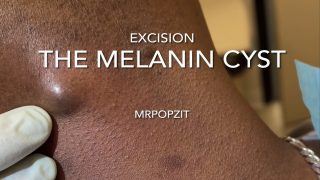 The Melanin Cyst. I answer common questions about skin tone and cyst contents. Cyst pop. MrPopZit 230726