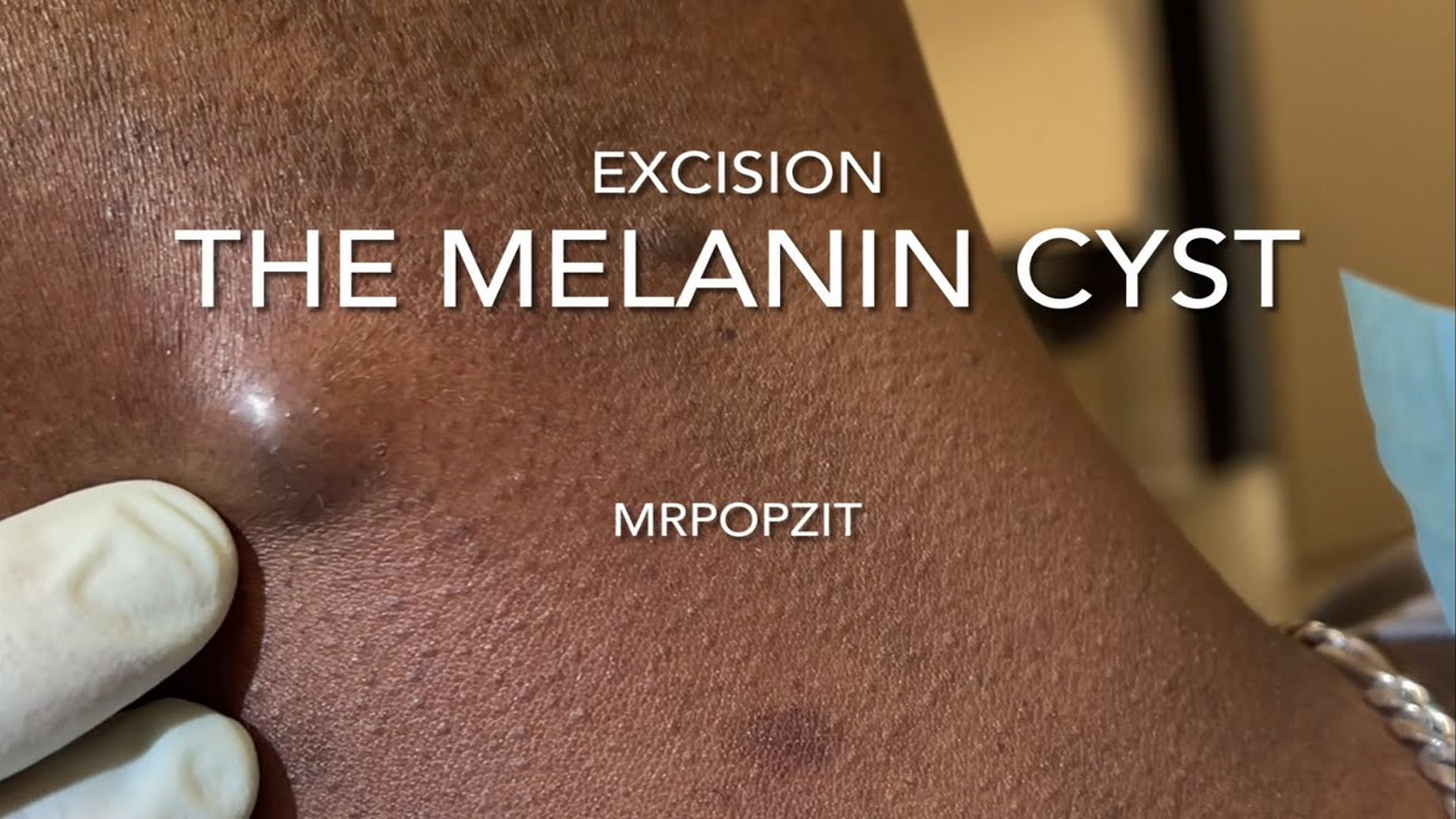 The Melanin Cyst. I answer common questions about skin tone and cyst contents. Cyst pop. MrPopZit 230726