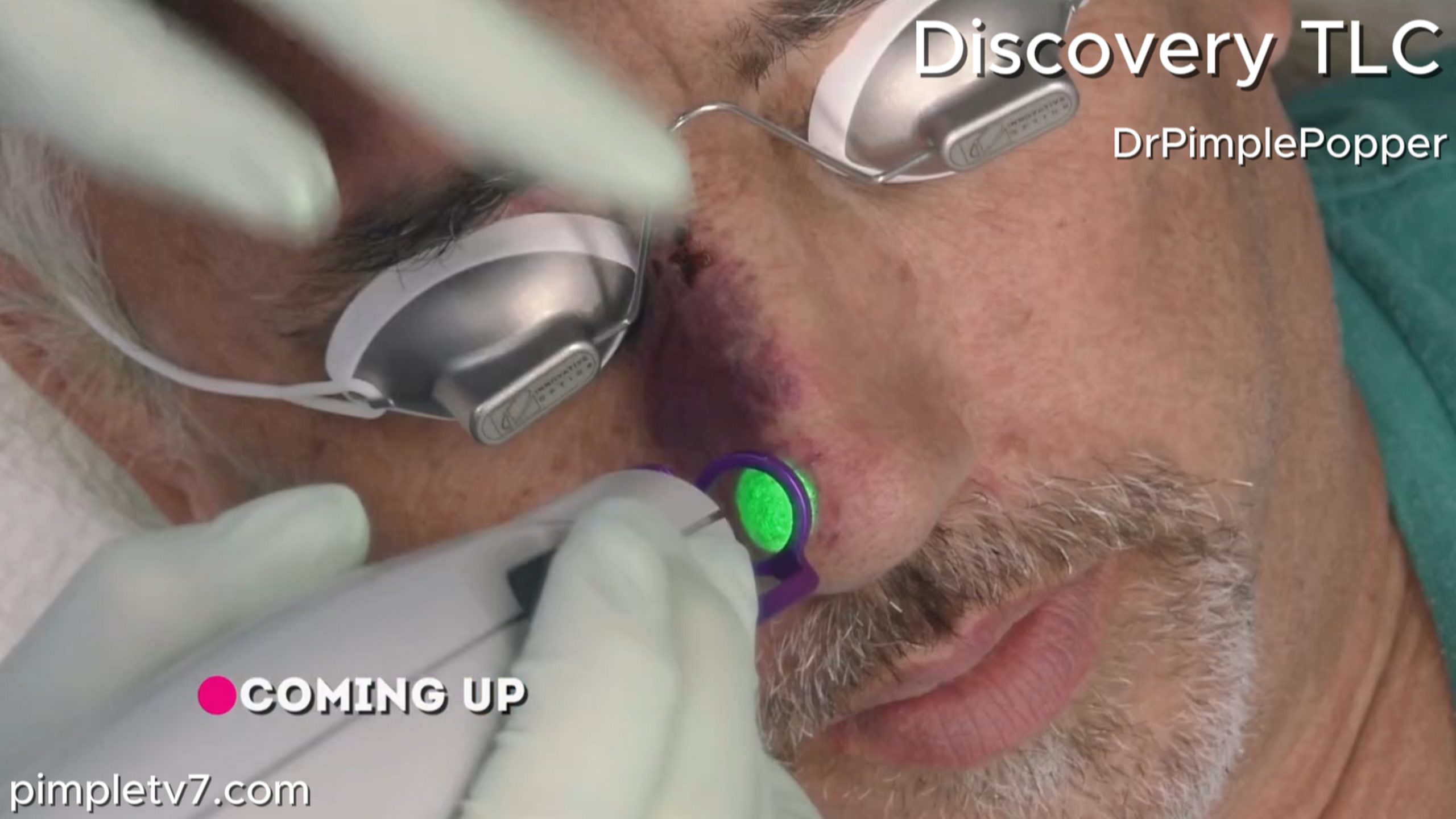 The dark purple birthmark on Eddie’s nose has made him a recluse. Dr. Pimple Popper 090726