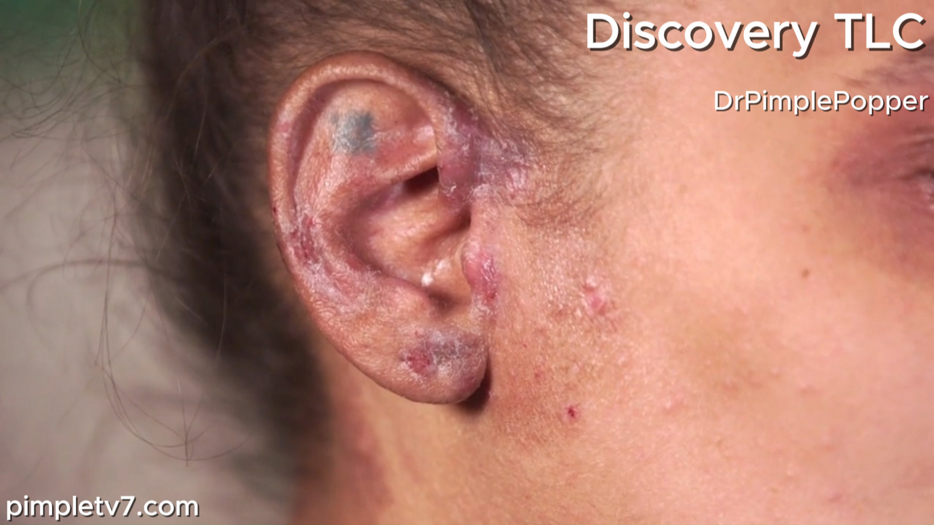 The itchy, painful rash on Nisa’s ears has spread to her face. Dr. Pimple Popper 220726