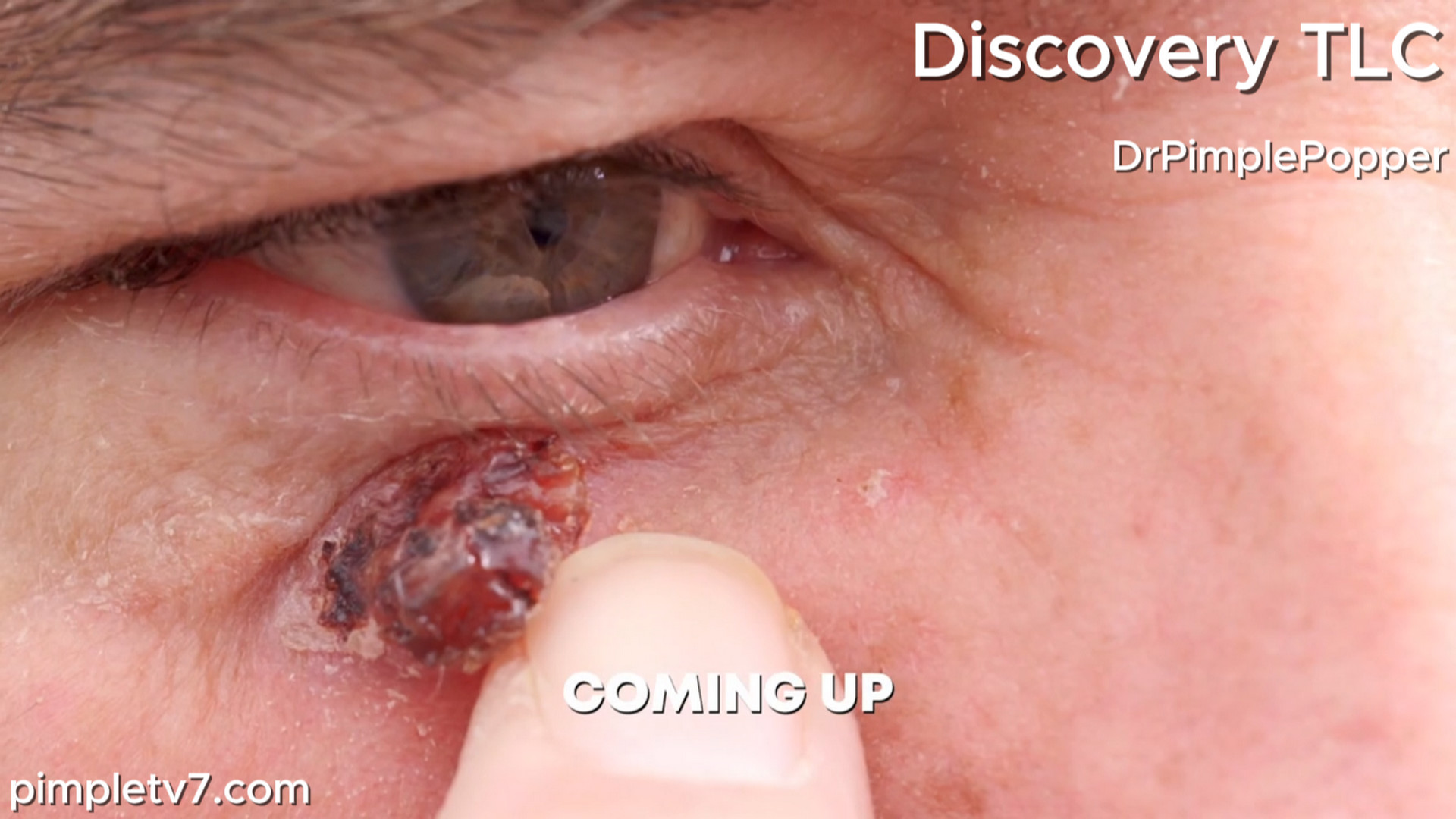 The mysterious bump on James’ cheek loves to bleed. Dr. Pimple Popper 200726