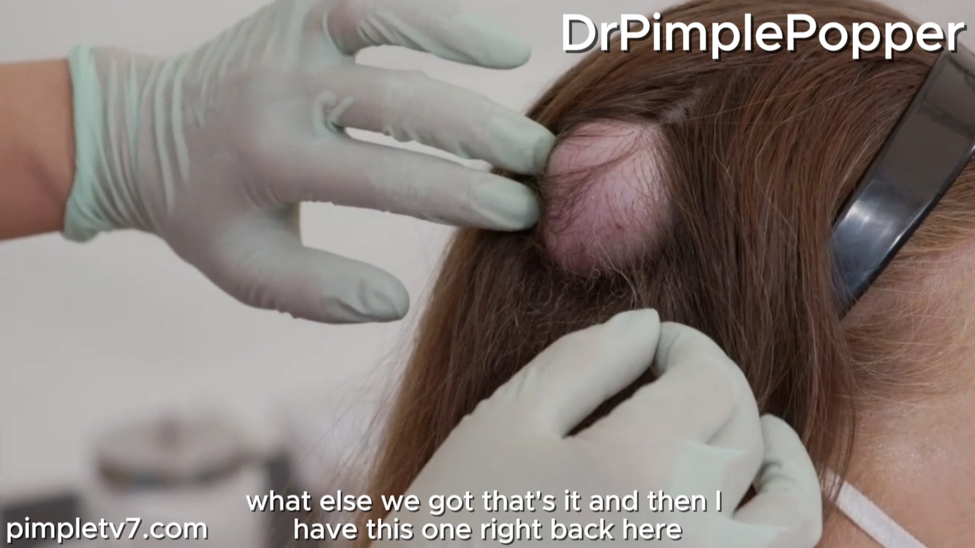 Twins Tracie and Stacie have numerous matching bumps on their heads that sometimes leak. Dr. Pimple Popper 280726