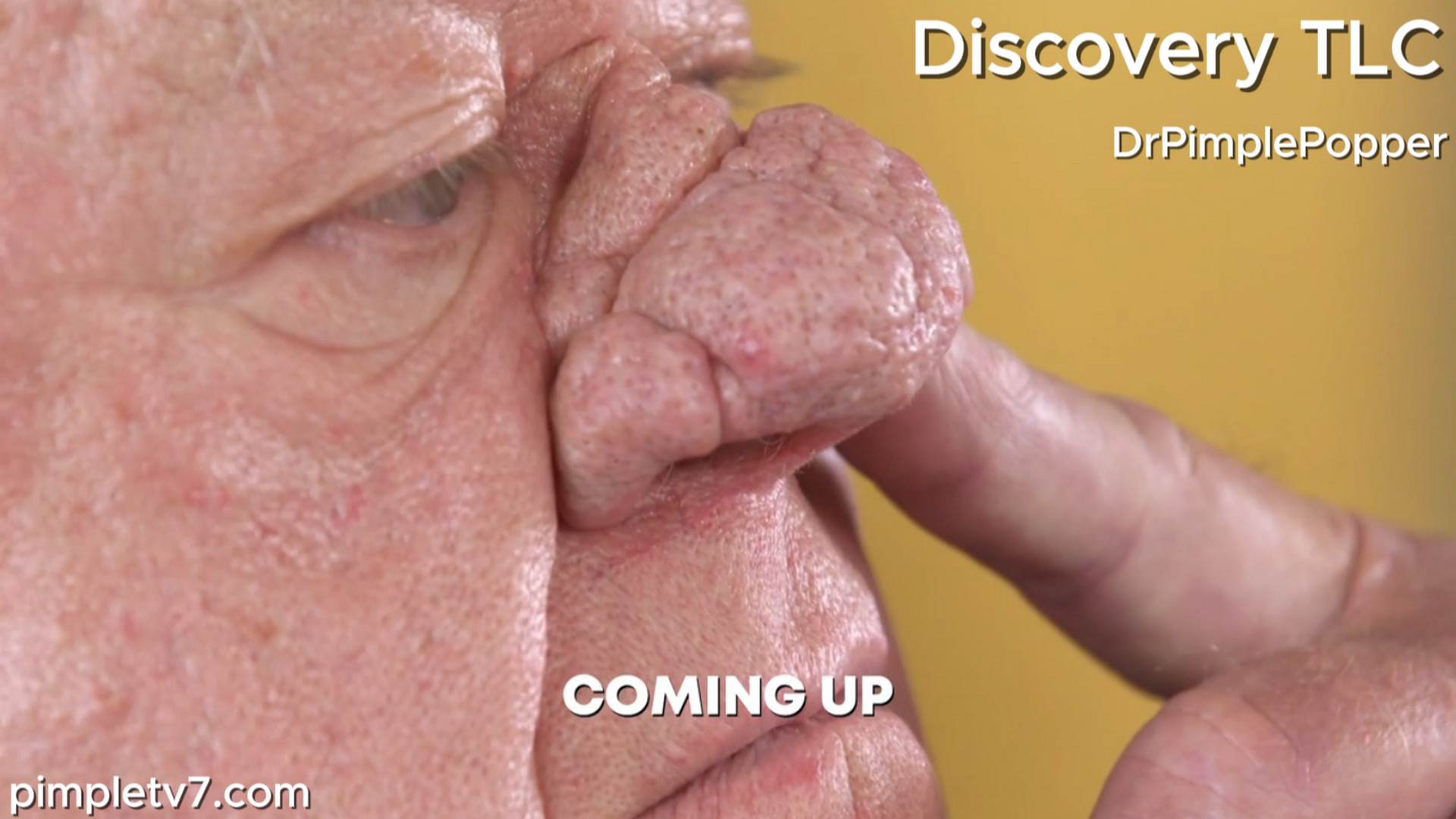 John has a nose the size of a plum and leans on his local family clinic for help. Dr. Pimple Popper 250726