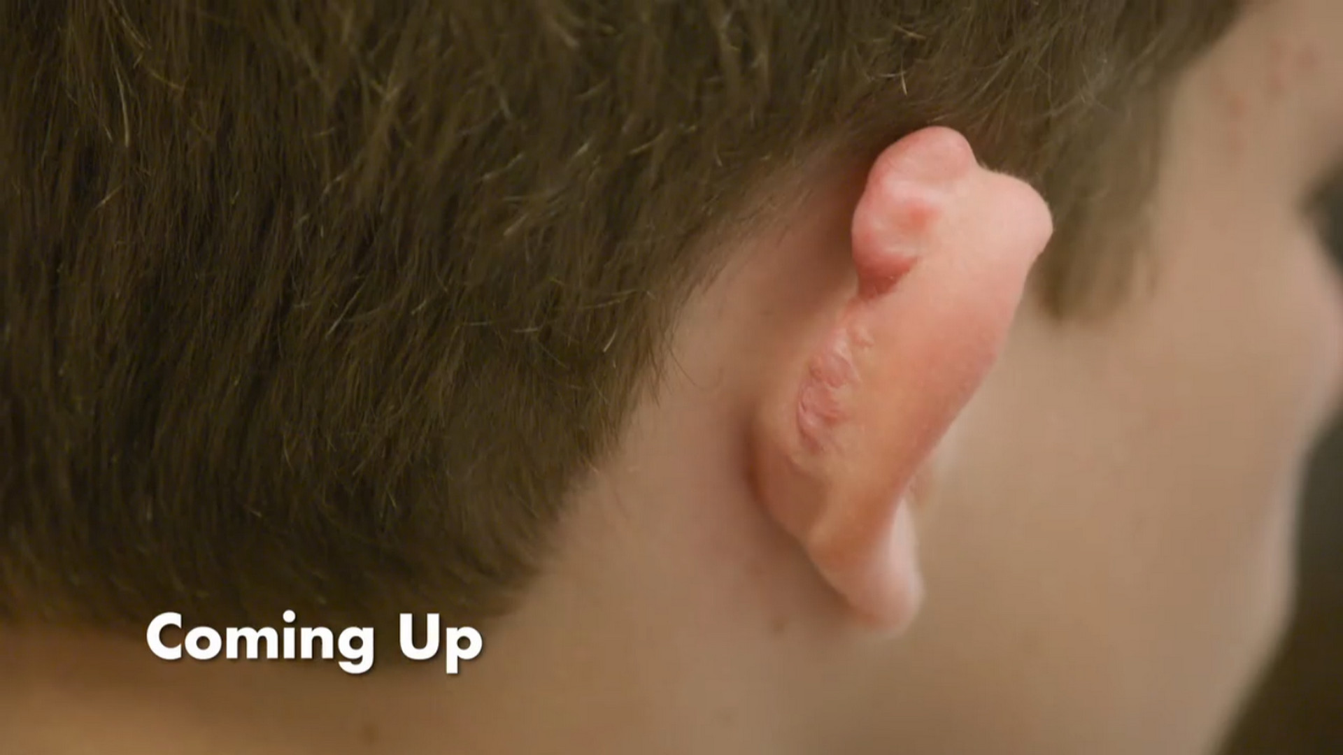 11-year-old Harley has a disfiguring keloid on his ear. SaveMySkin 260826
