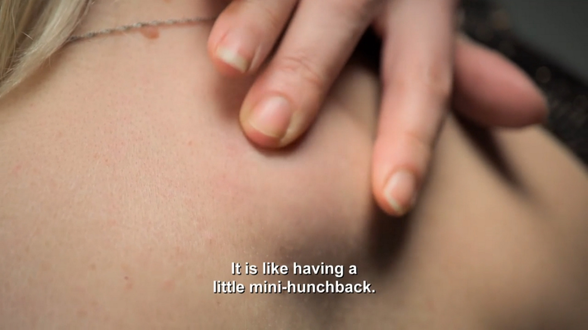 Amanda has an annoying lipoma on her back. SaveMySkin 290826