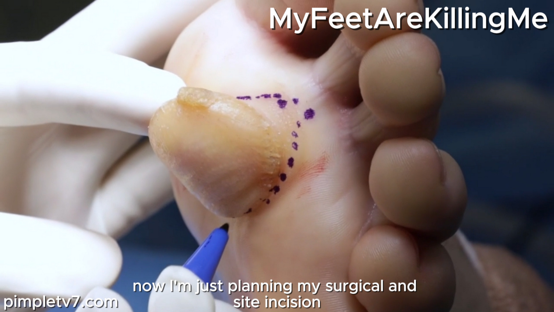A man with an enormous lump on his foot creates a mystery for Dr. Vincent. MyFeetAreKillingMe 250826