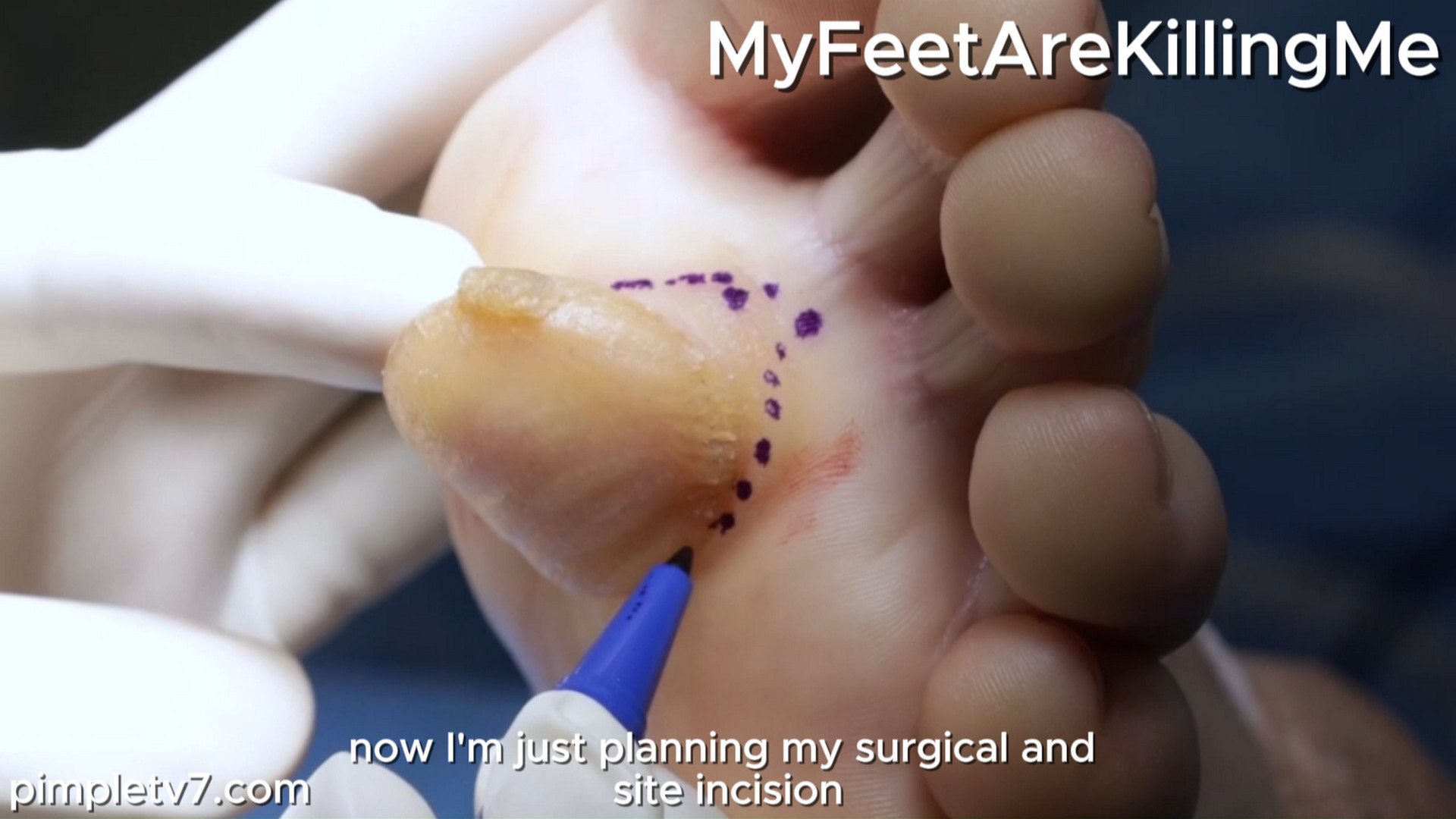 A man with an enormous lump on his foot creates a mystery for Dr. Vincent. MyFeetAreKillingMe 090826