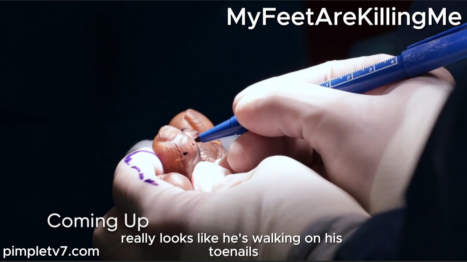 A man with curled toes makes for a challenging surgery. MyFeetAreKillingMe 300826