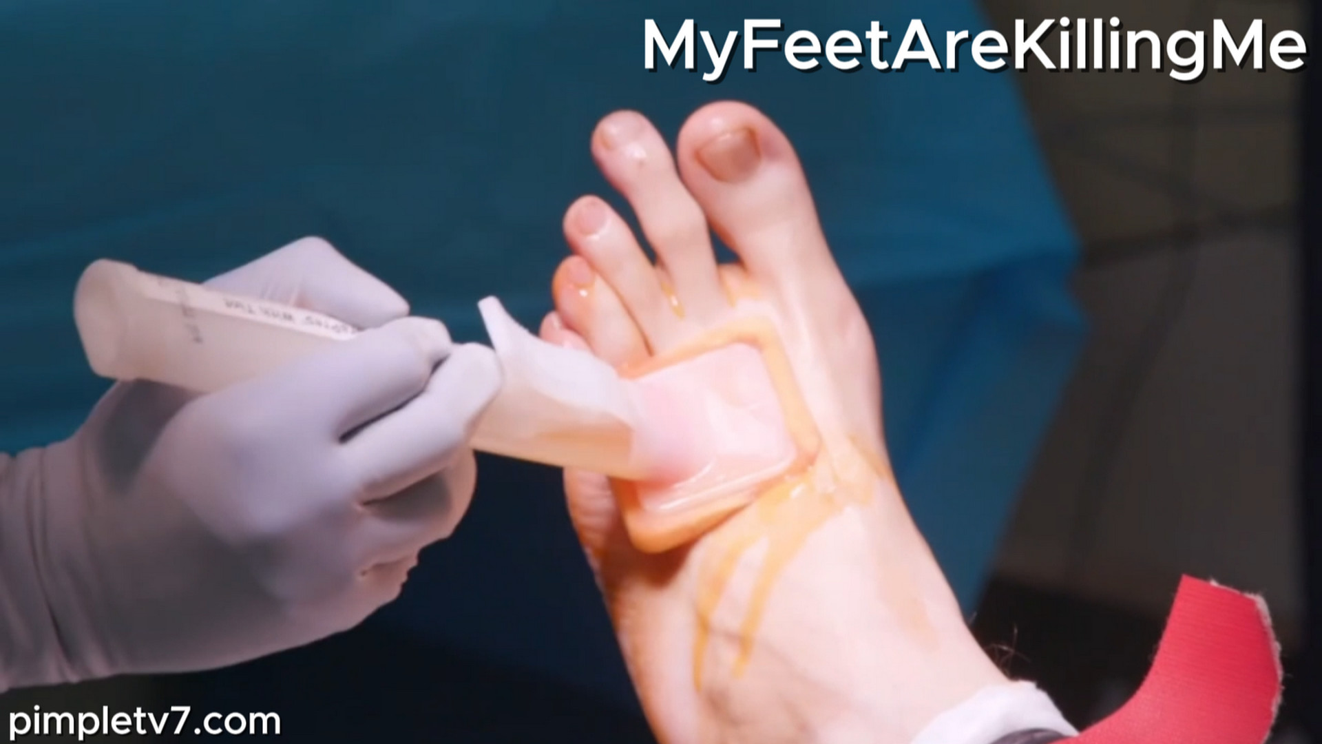 A man with incredibly long toes. MyFeetAreKillingMe 280826